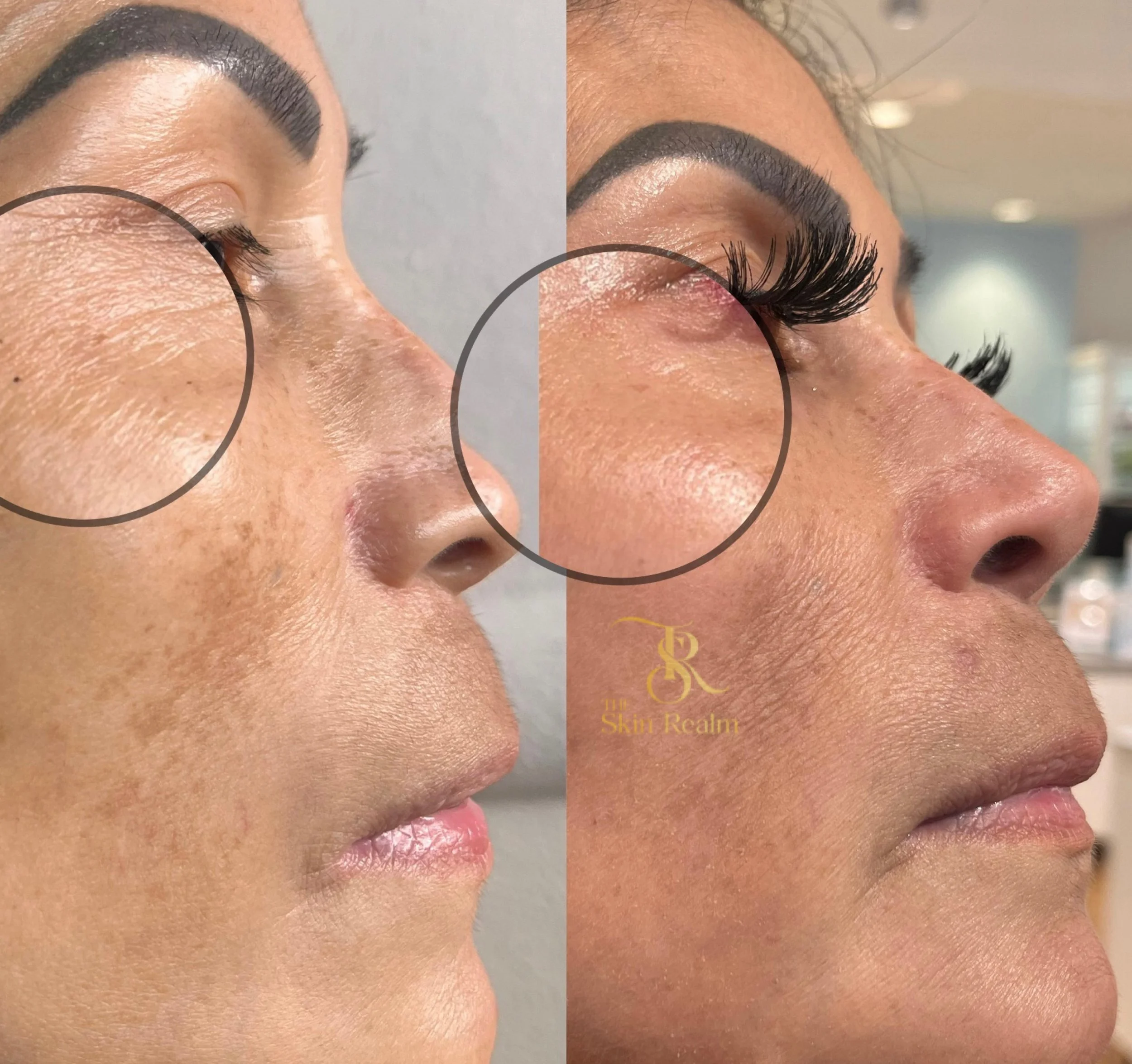 Her 2nd peel for anti aging, wrinkles, and hyperpigmentation