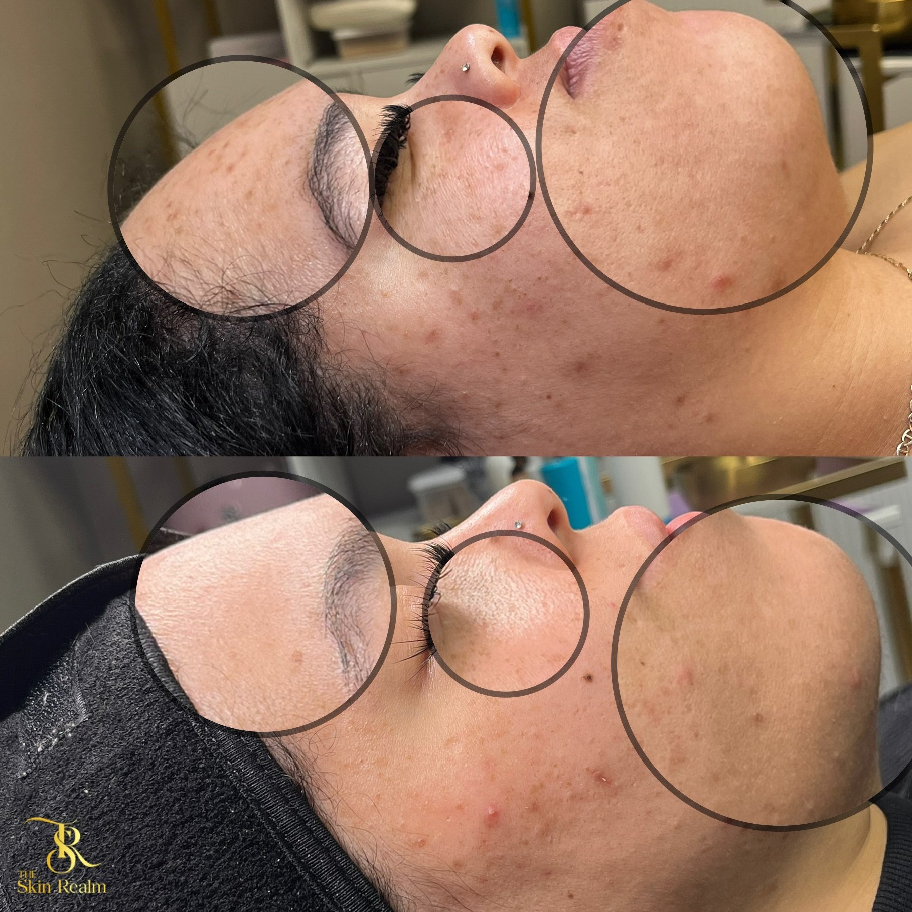 1 session of Zena Algae Peel for Sun Damage (Sun Spots) , Uneven Skin Tone, Post Inflammatory Hyperpigmentation.