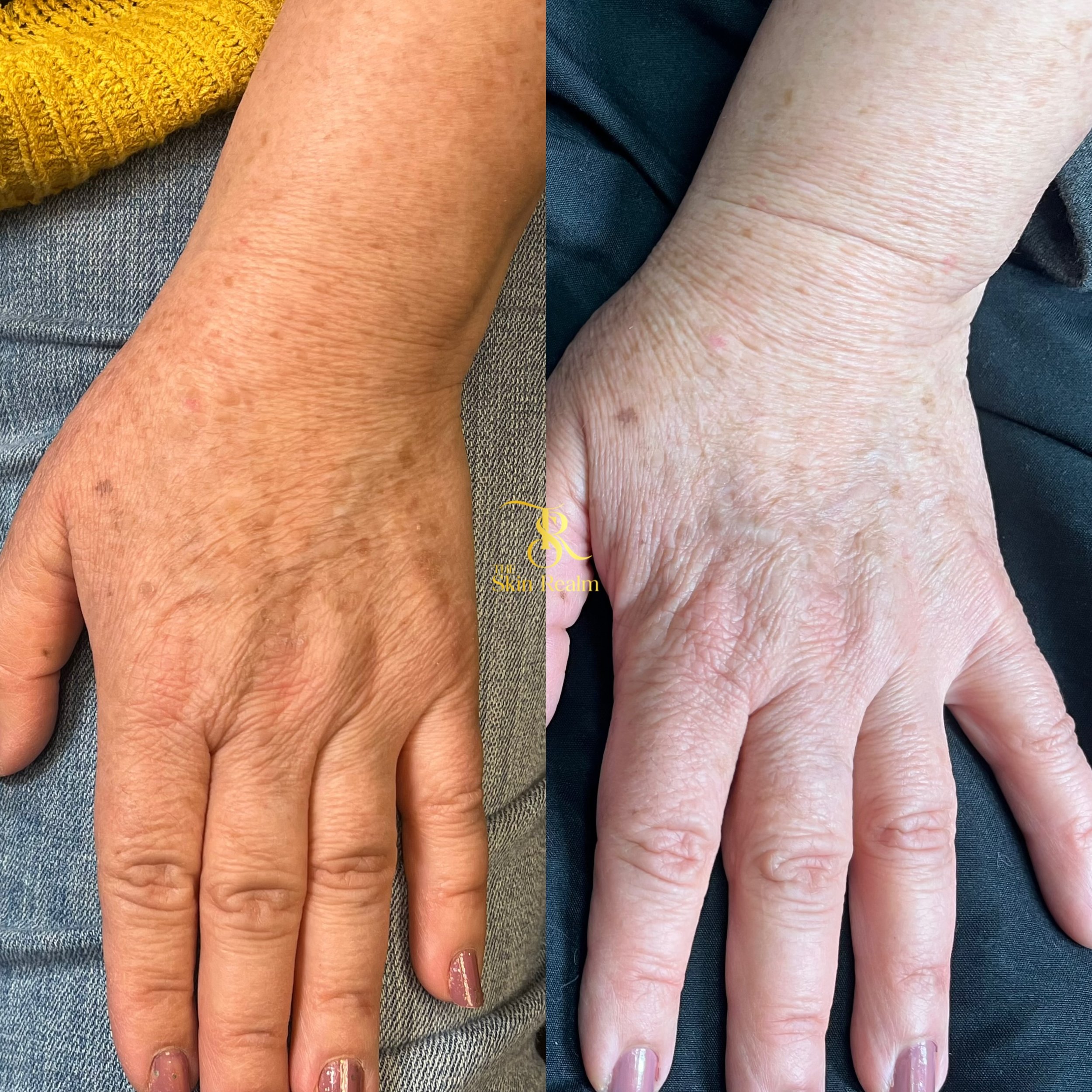 1 session of Zena Algae Peel for Wrinkles and Sun Spots