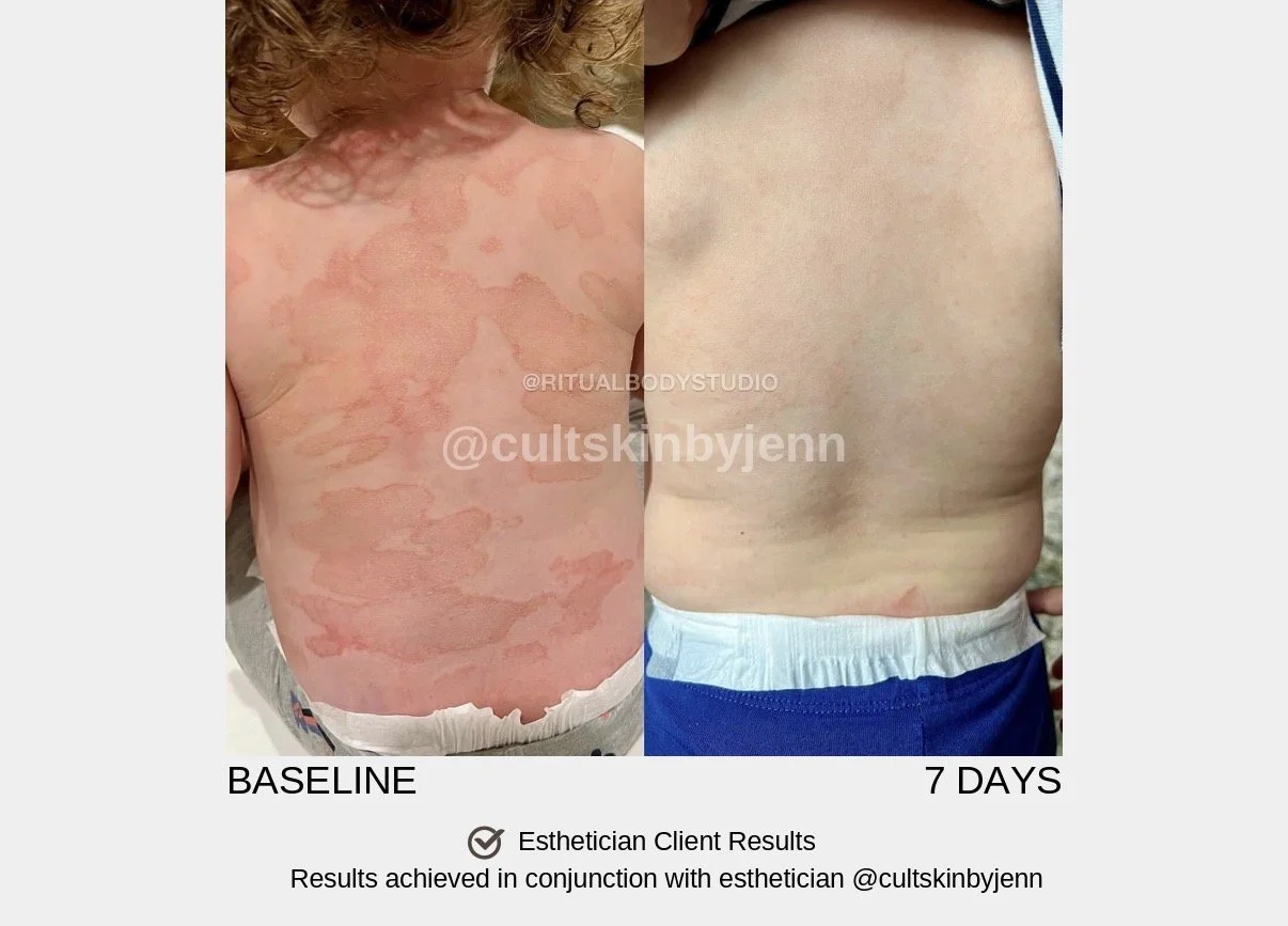 Comparison of back skin showing severe redness and irritation at baseline and clear skin after 7 days of treatment.