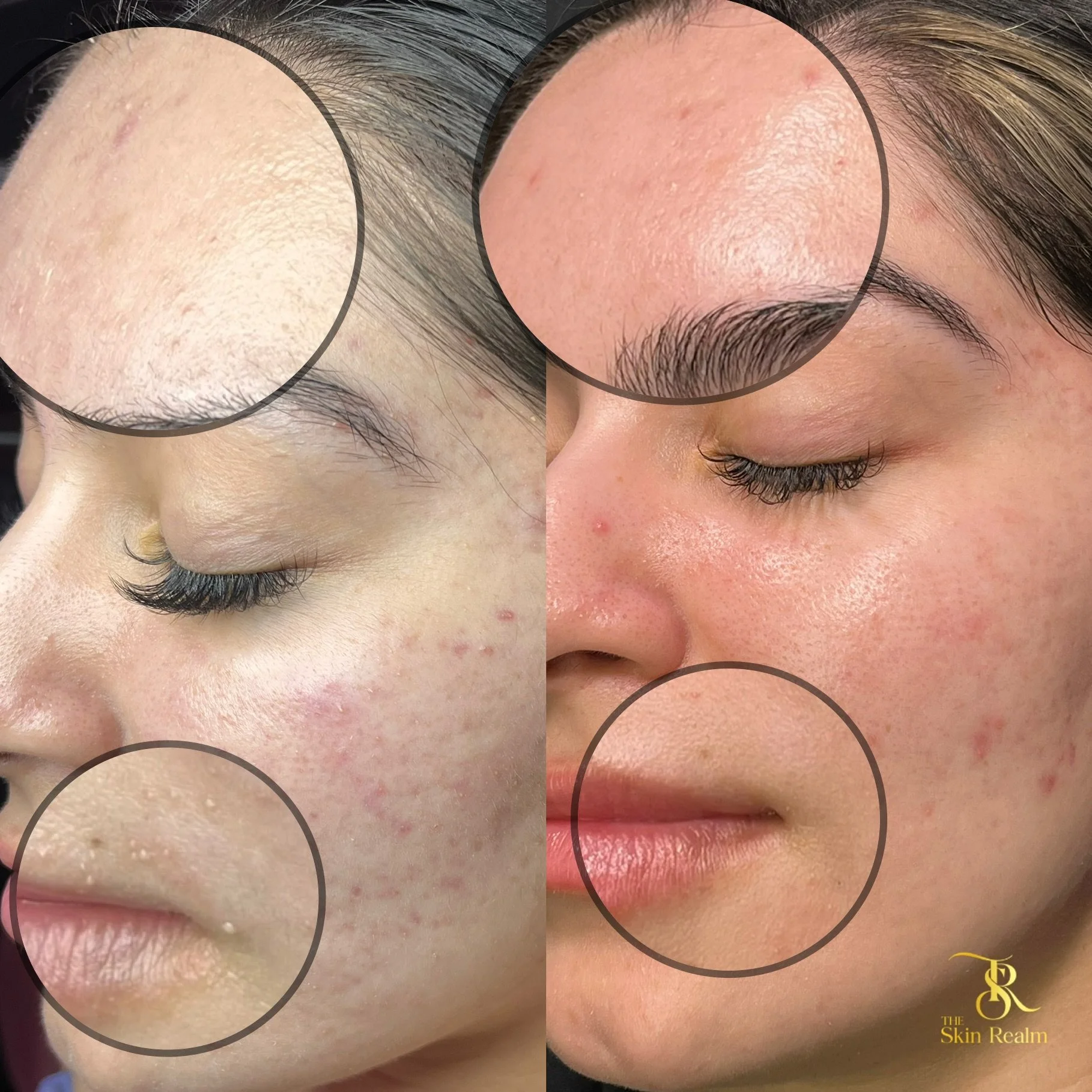 A series of Mandelic Facials for Acne and Brightening Facials for Post Inflammatory Hyperpigmentation