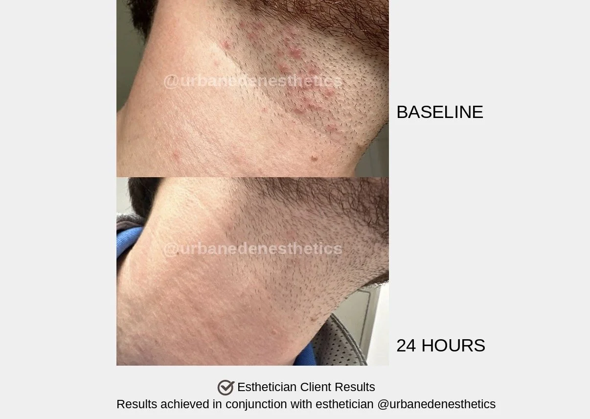 Comparison of underarm skin before and 24 hours after treatment, showing reduced redness and irritation.