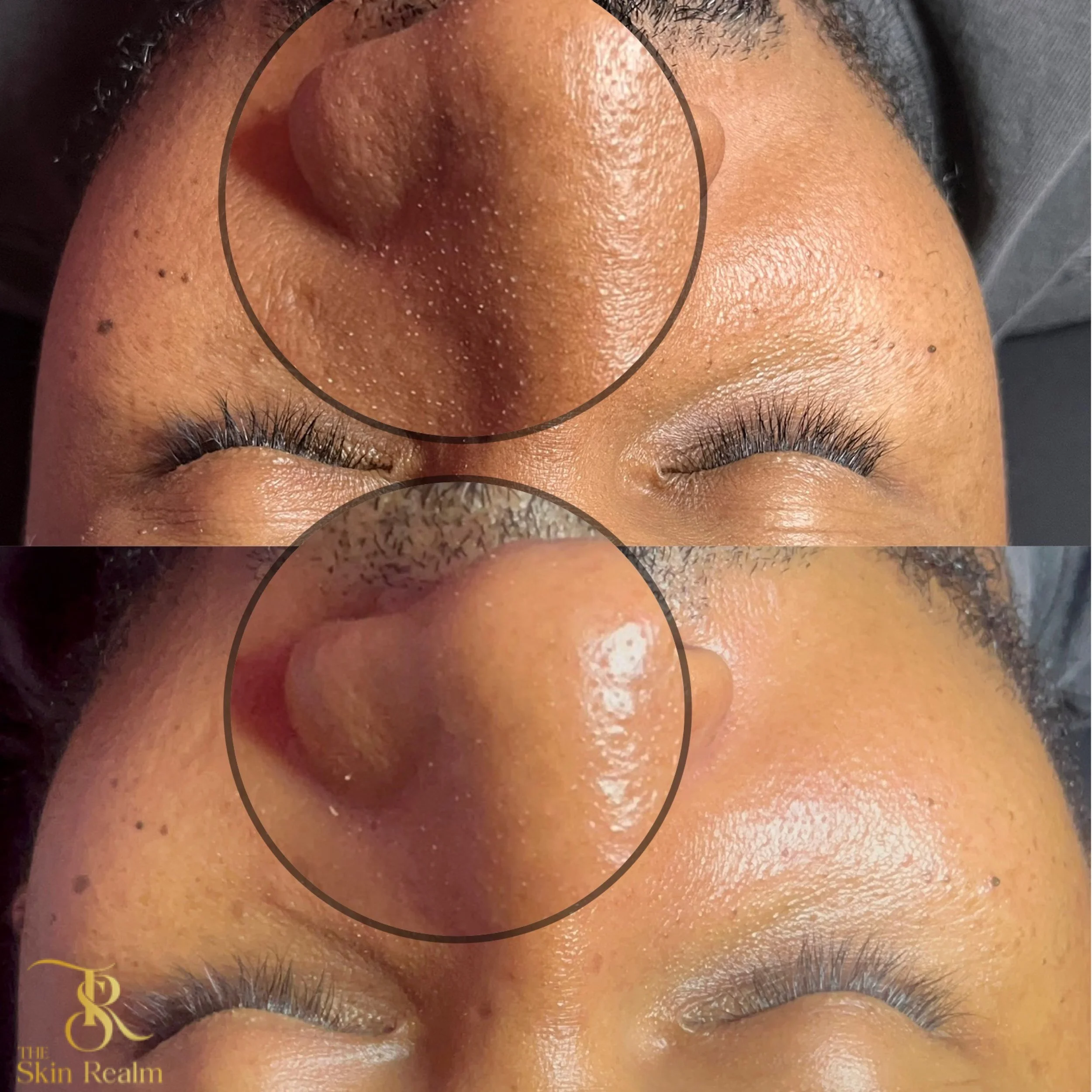 Extractions for removal of sebaceous filaments accumulated on the T zone