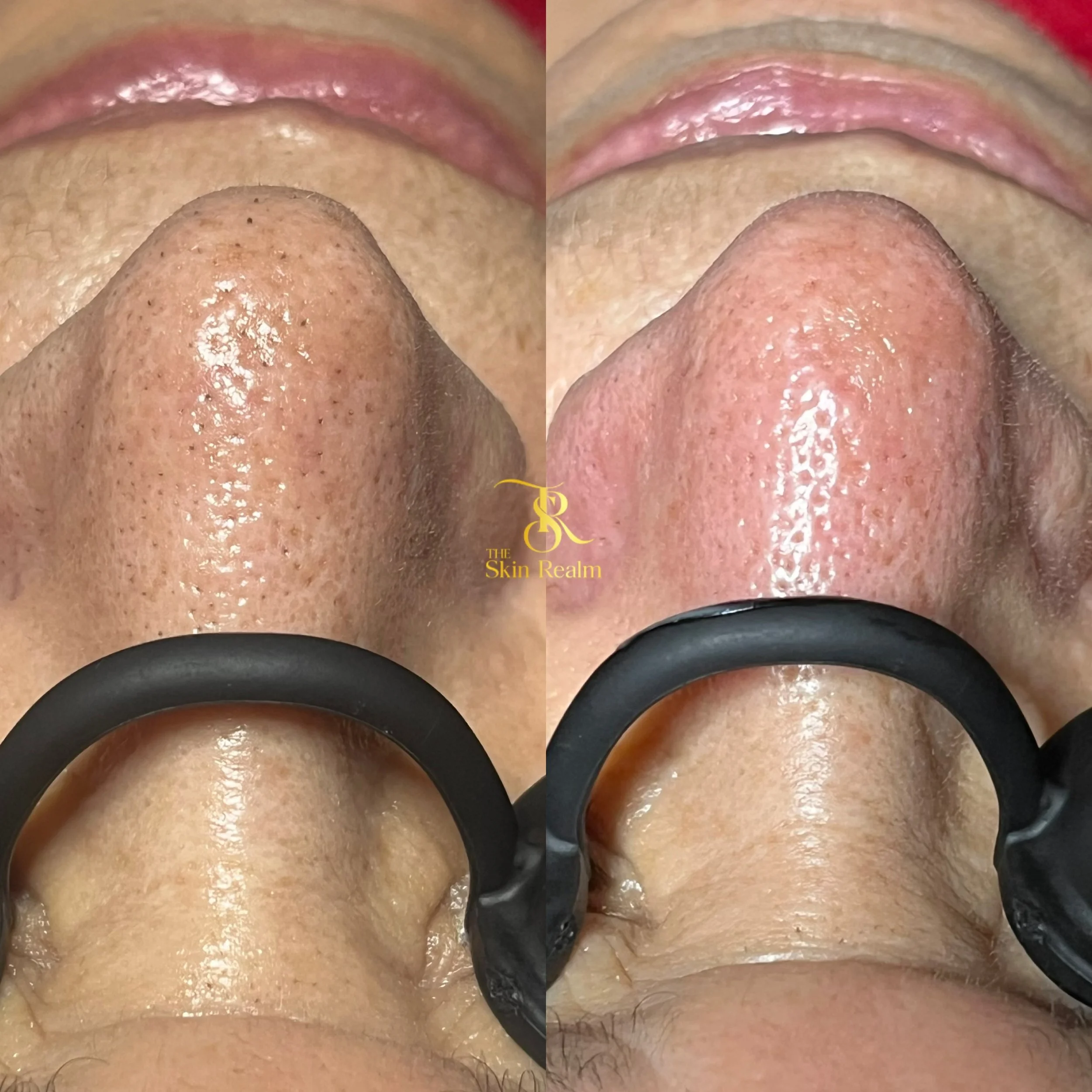 Results of extractions to remove blackheads and unclog the pores