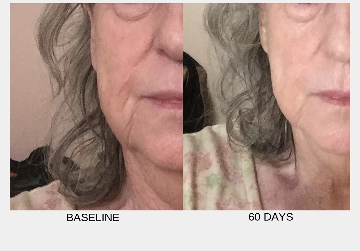 Comparison of a woman's face showing signs of aging at baseline and after 60 days, with reductions in wrinkles.