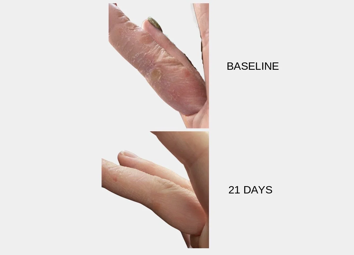 Comparison of dry, cracked skin on a finger at baseline and 21 days.