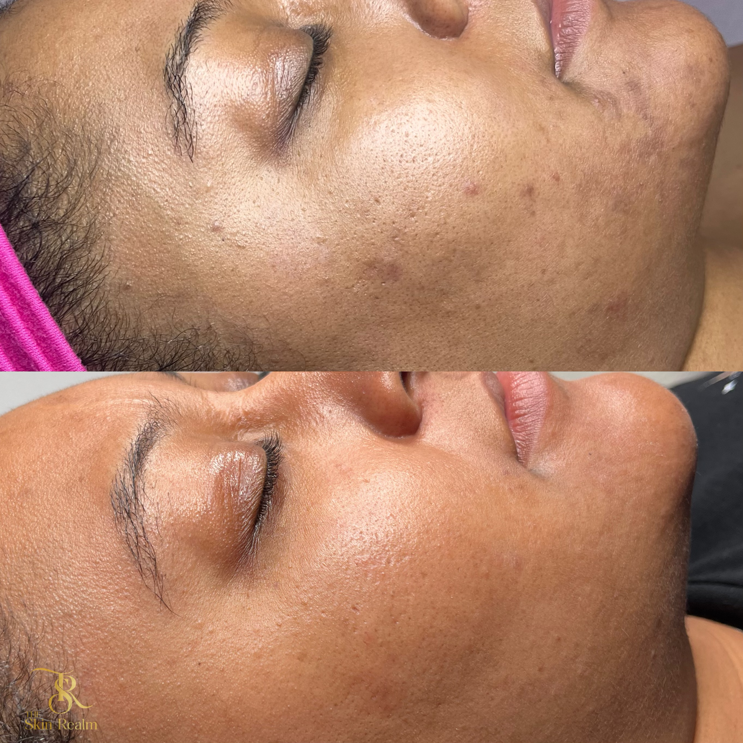 A series of 1 Mandelic Facial & 3 Brightening Facials