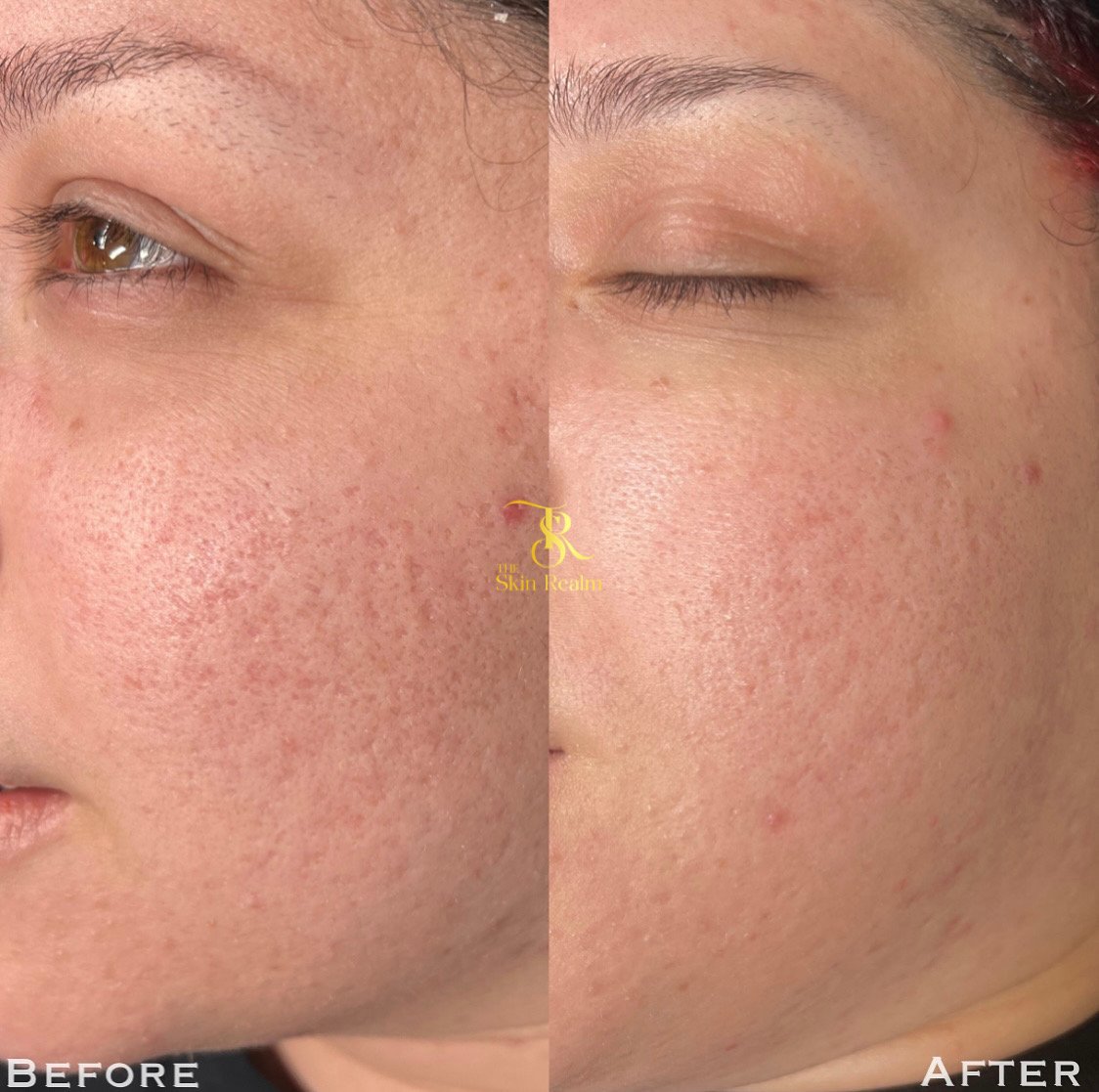 1 session Zena Algae Peel for Acne Scarring