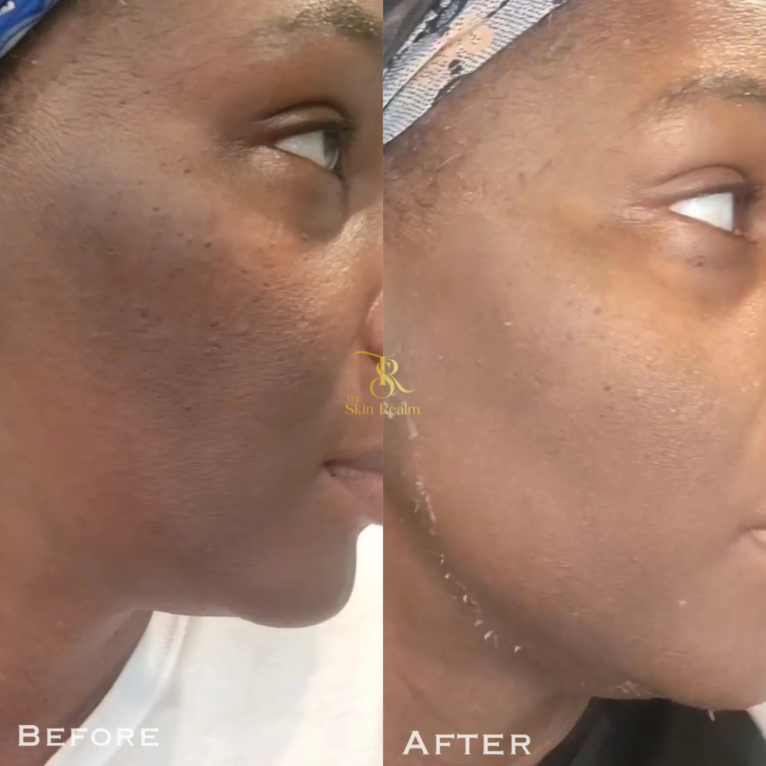 1 session of Zena Algae Peel for texture & hyperpigmentation