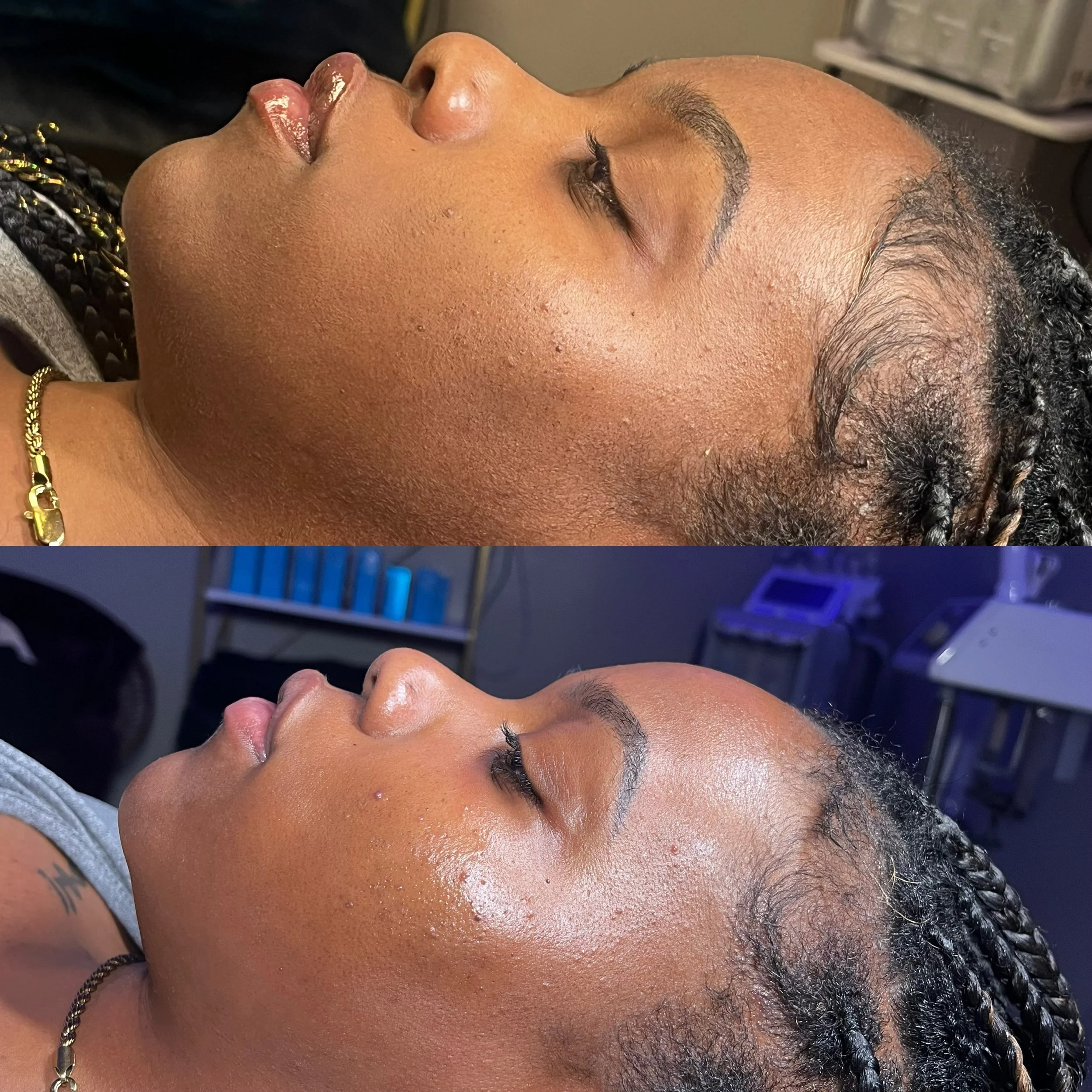 A Dermaplane Facial to remove dead skin and smooth texture