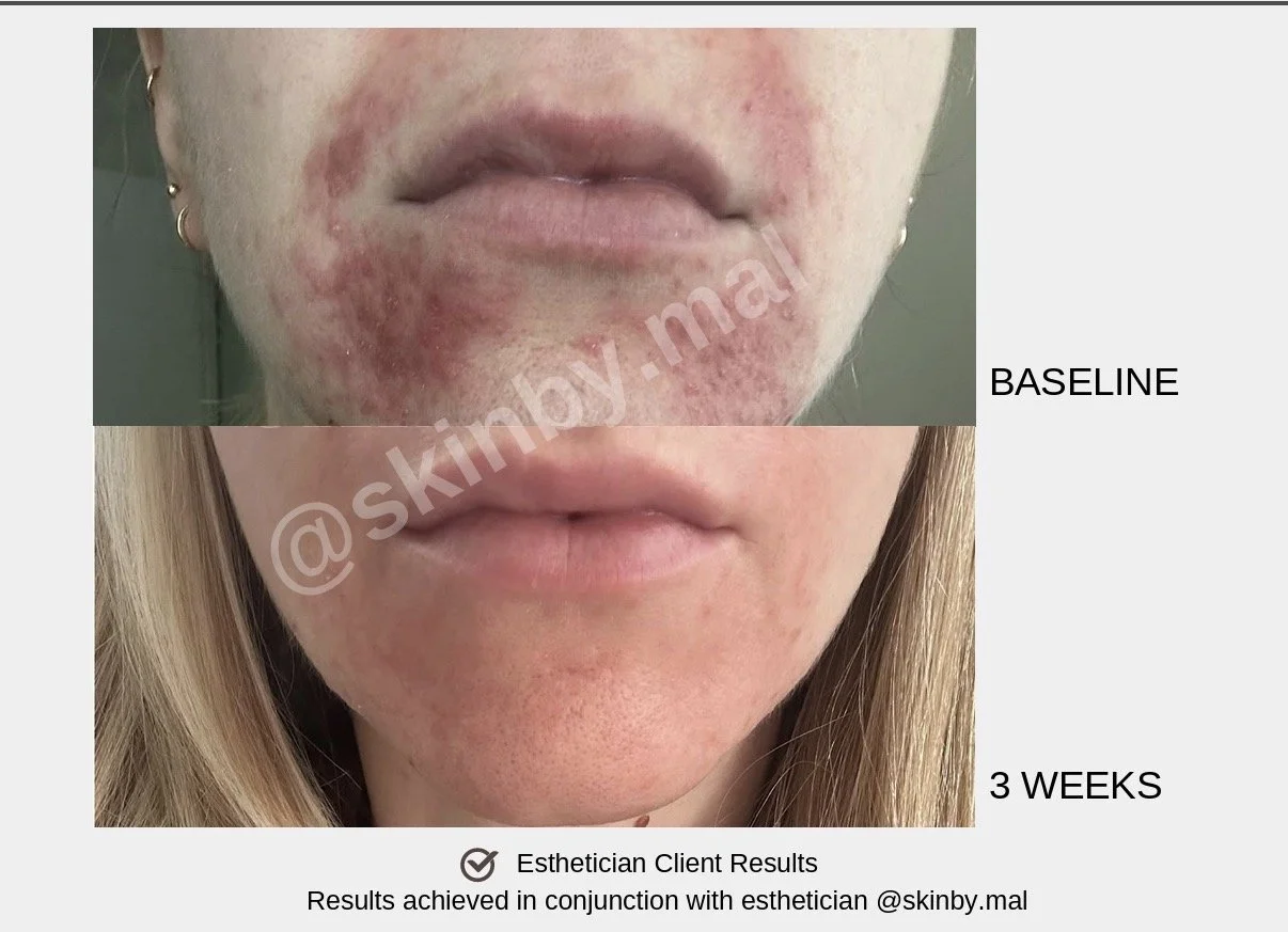 Side-by-side comparison of facial skin, showing improvement in skin condition from baseline to 3 weeks after treatment, with less redness and irritation.