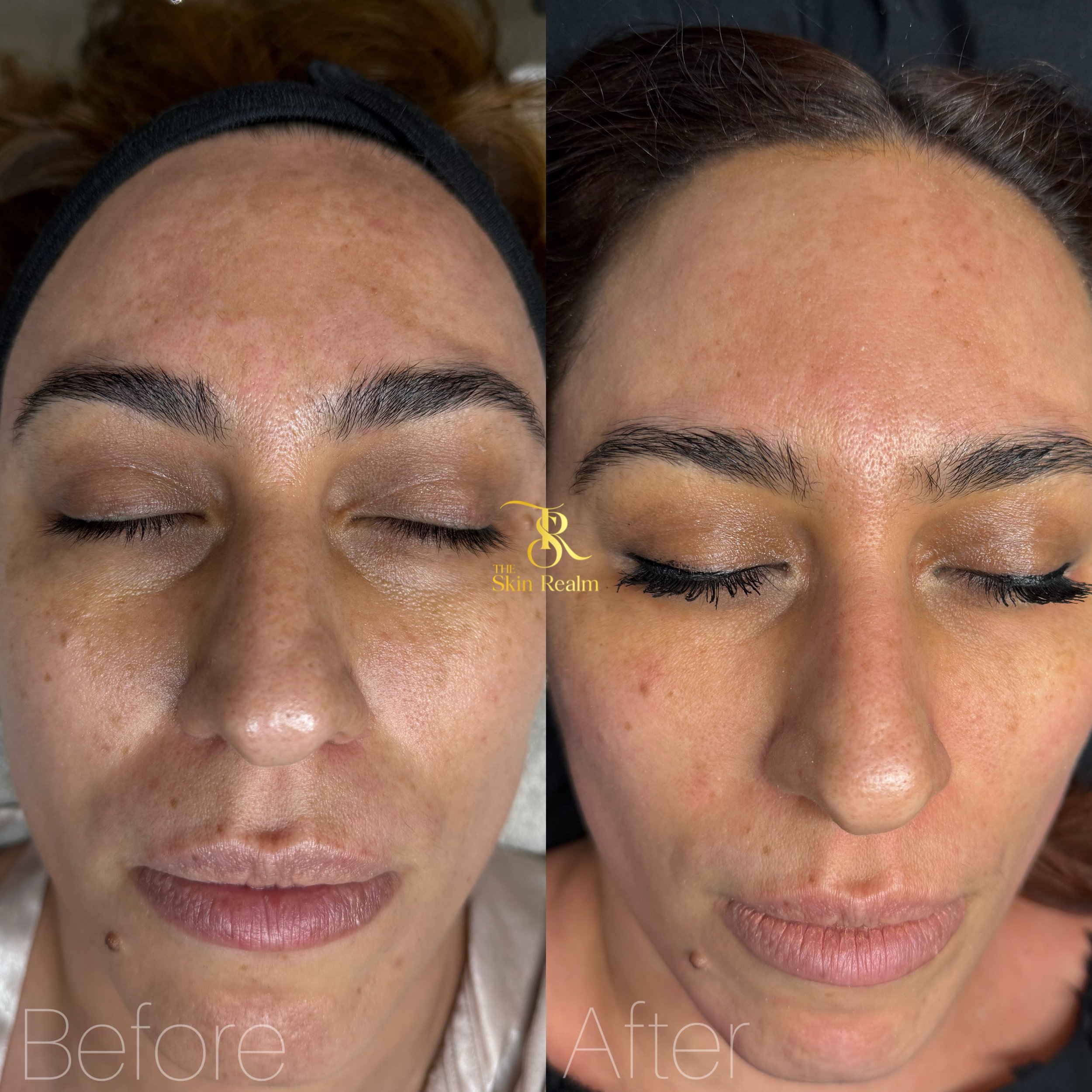 1 session of Zena Algae Peel for Sun Damage, Pigmentation, and Rejuvenation