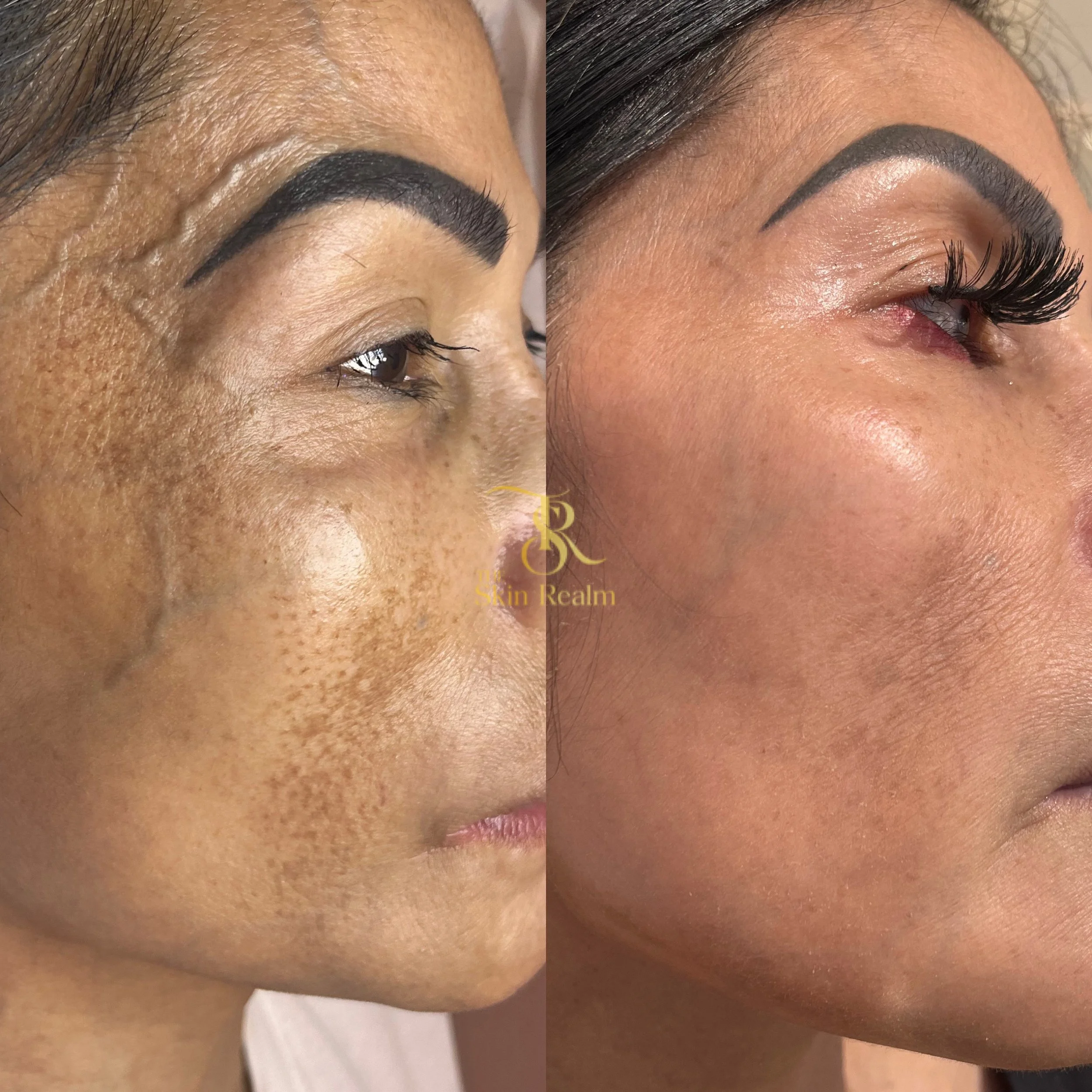 2 sessions of Zena Algae Peel for anti aging and stubborn melasma