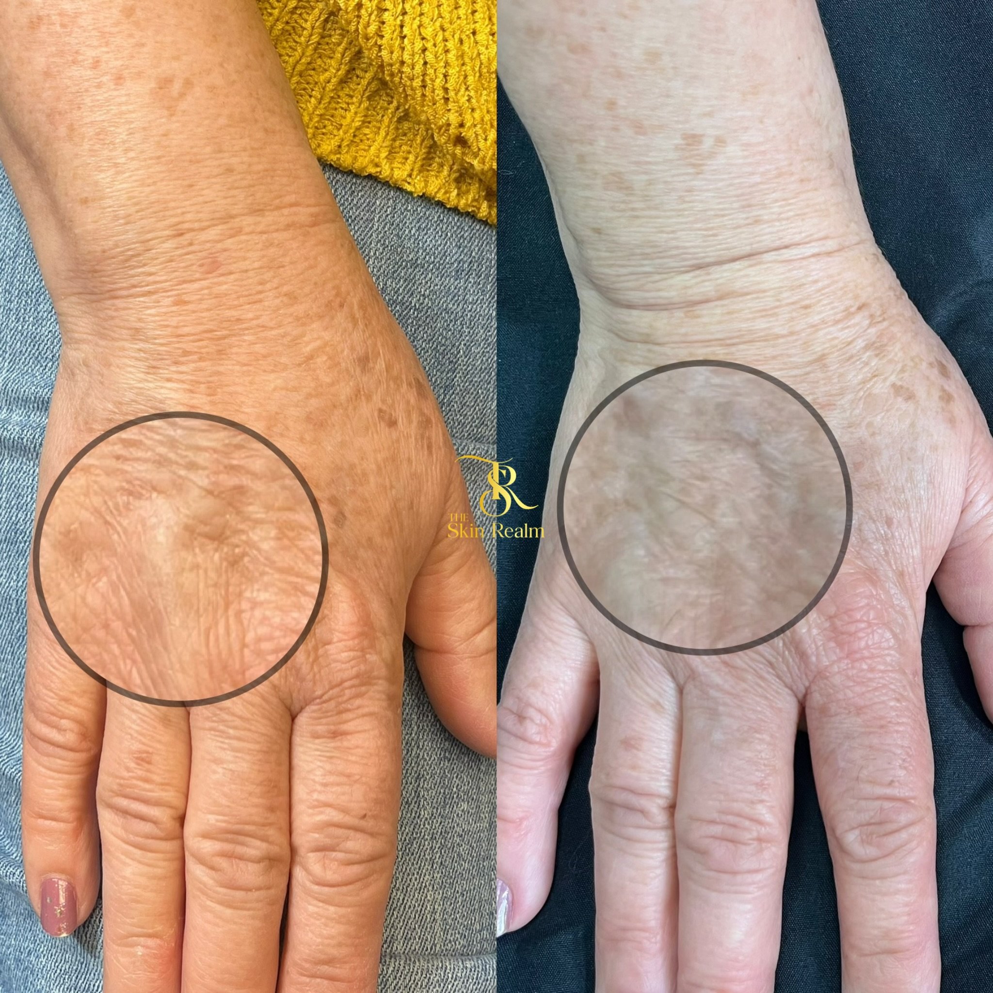 1 session of Zena Algae Peel for Wrinkles and Sun Spots