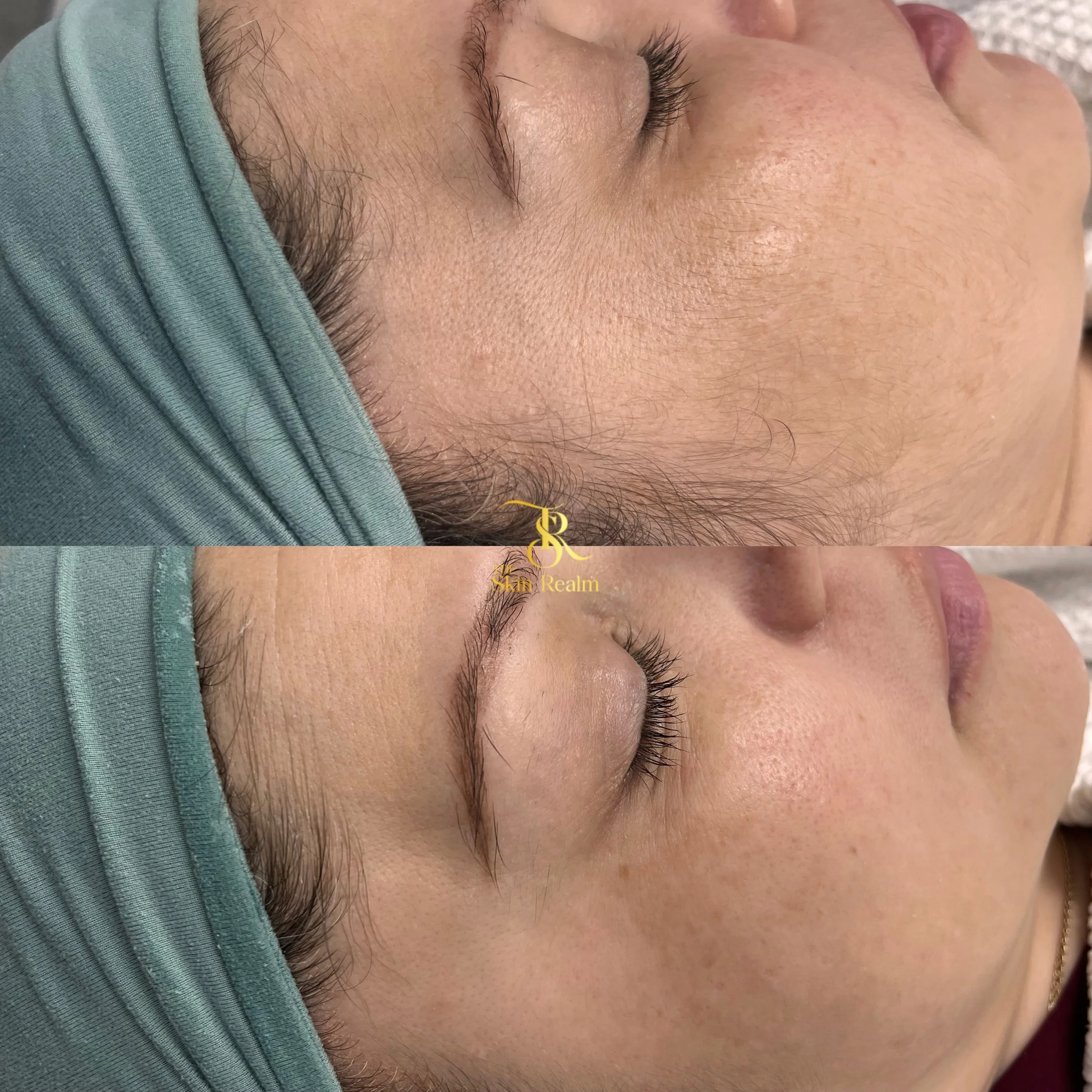 A Dermaplane Facial to remove vellus hair and remove dead skin