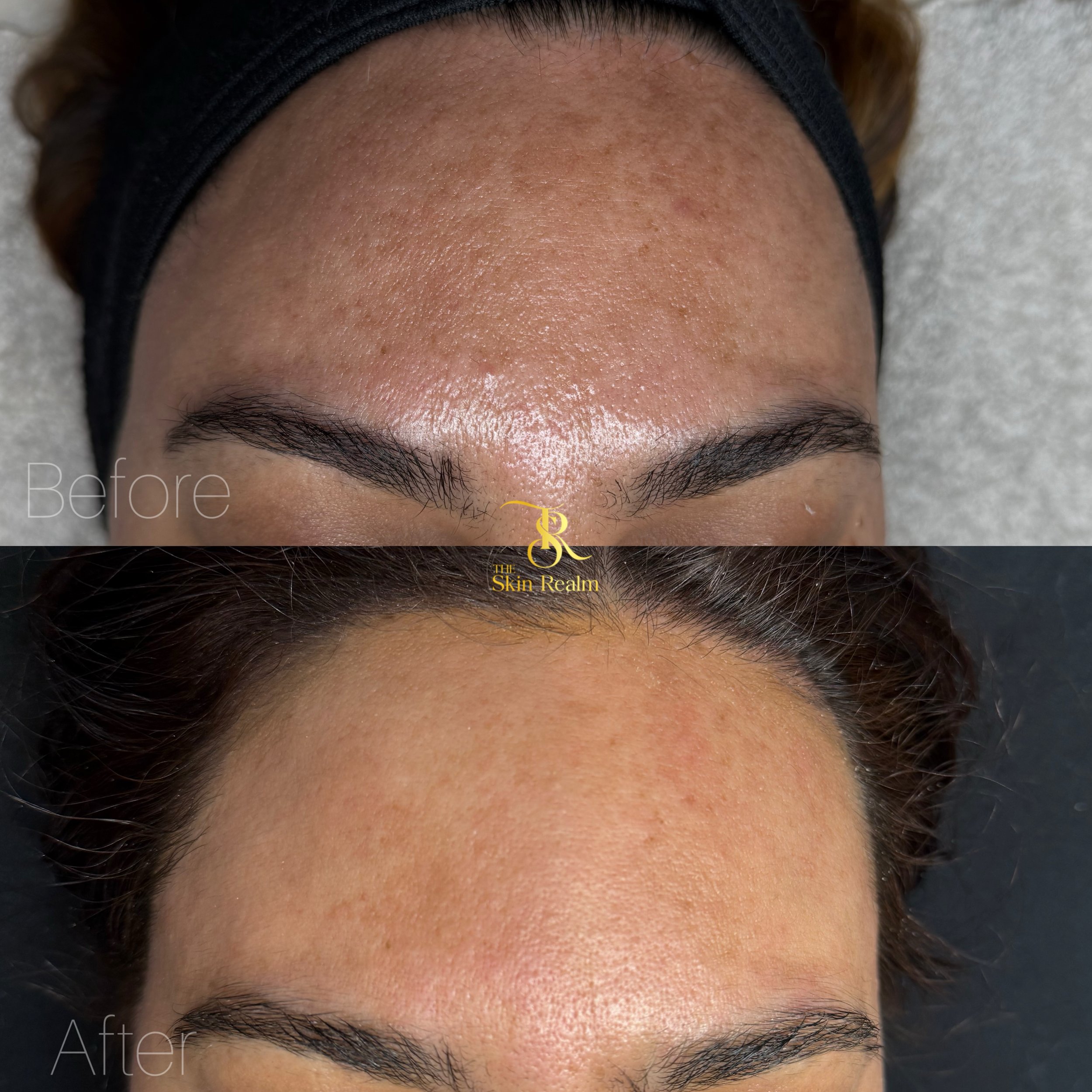 1 session of Zena Algae Peel for Sun Damage and Pigmentation
