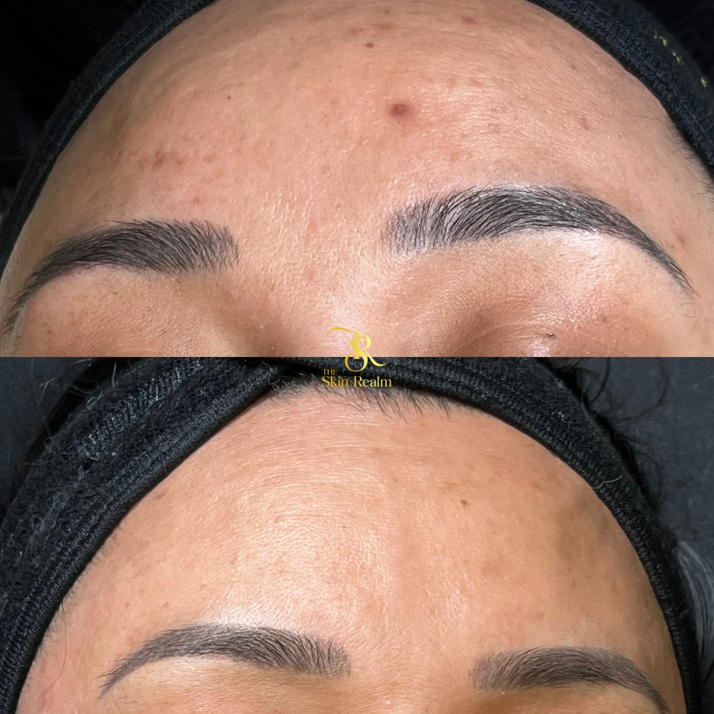 A series of Brightening Facials for Post Inflammatory Hyperpigmentation