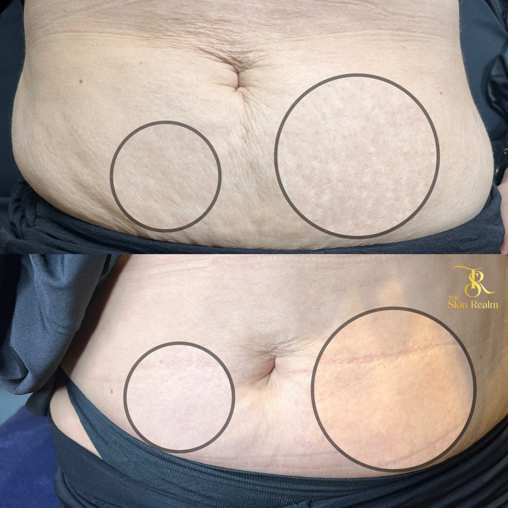 1 session of Zena Algae Peel for stretchmarks and texture