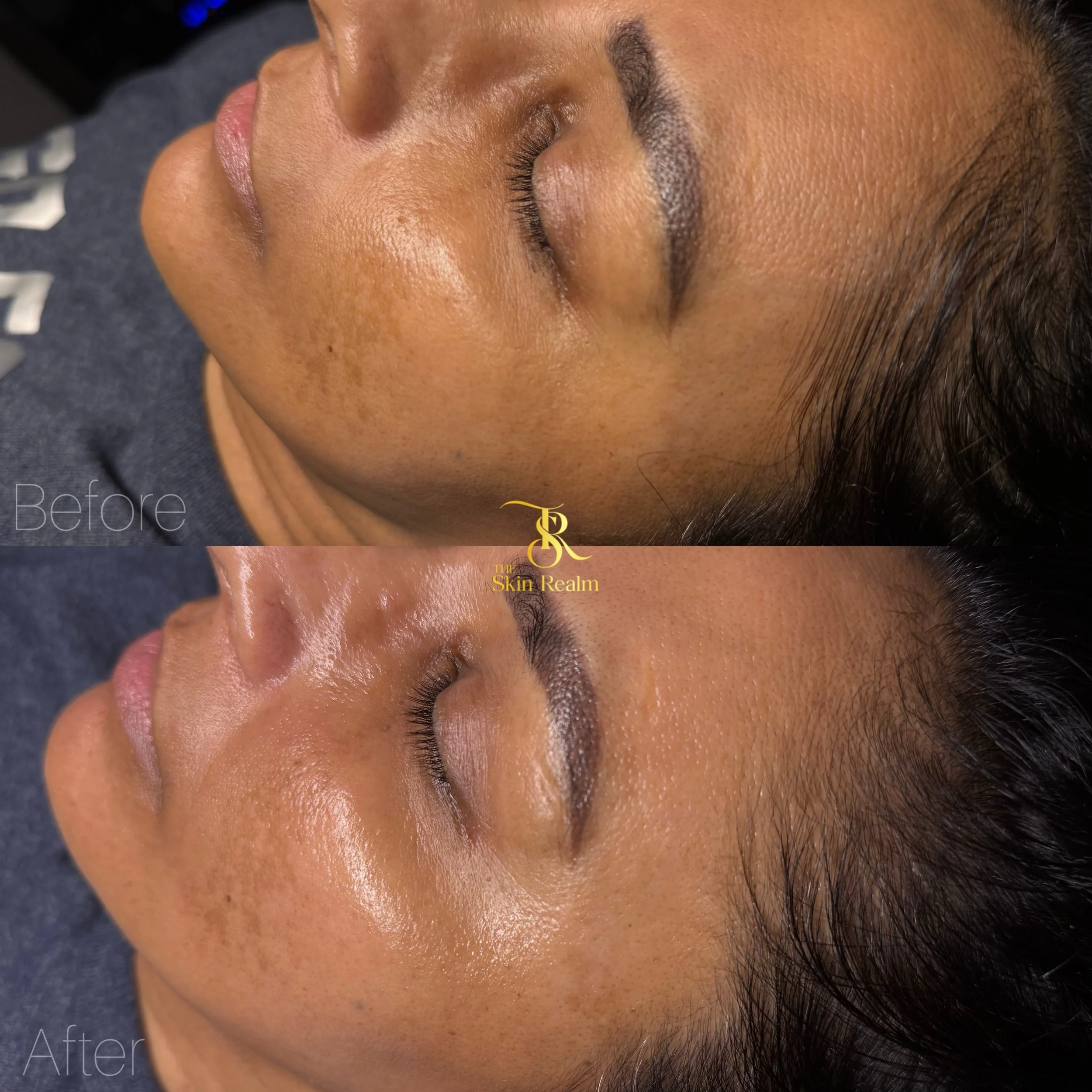 A Dermaplane Facial to remove vellus hair and remove dead skin revealing a fresh glow and a new layer of skin