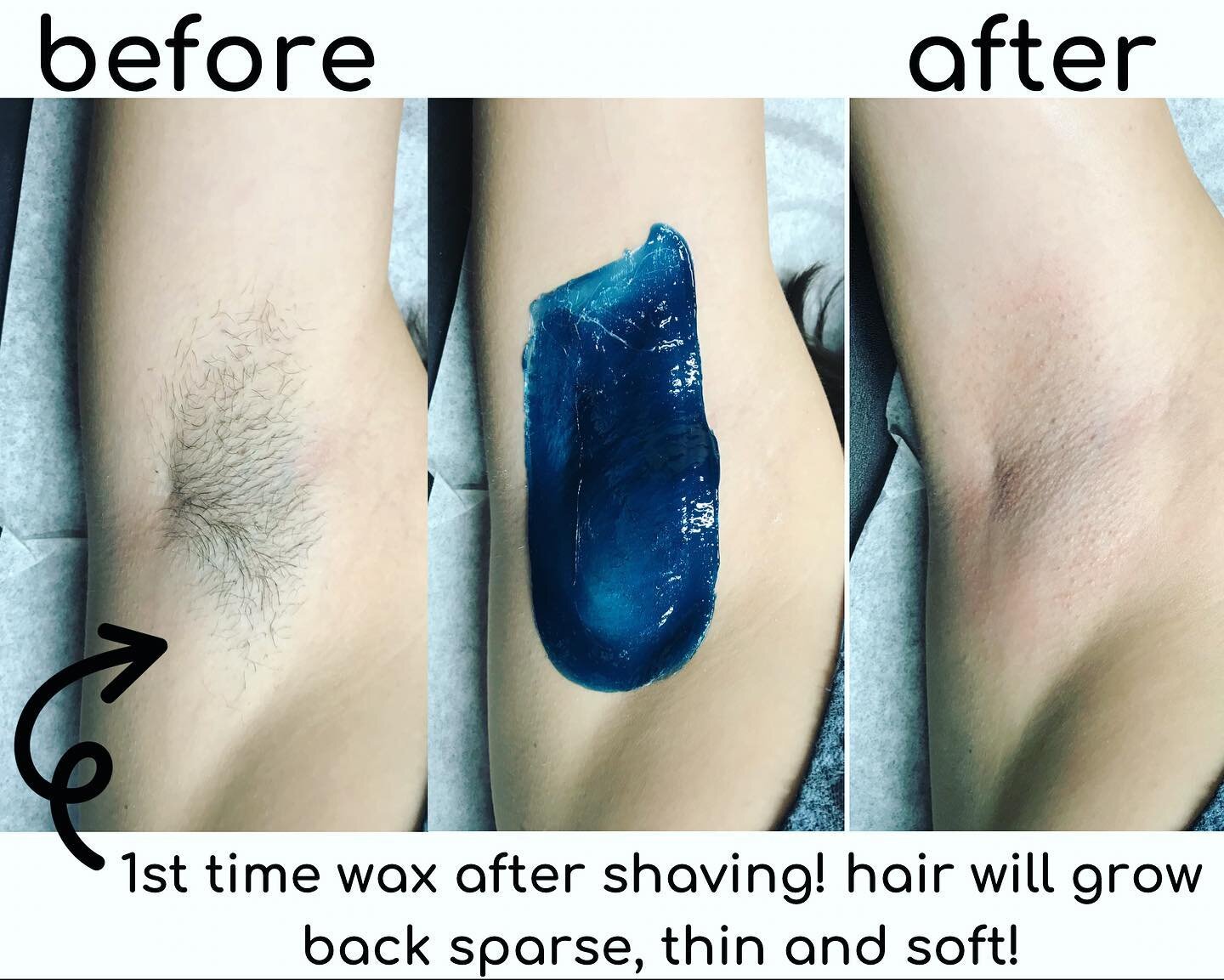 before and after of a clients first time underarm wax after shaving @noodwax ! after the first wax/sugar hair will come back thin, sparse and soft- which makes it sooo much easier to grow out the next time! underarm wax/sugar is recommended every cou