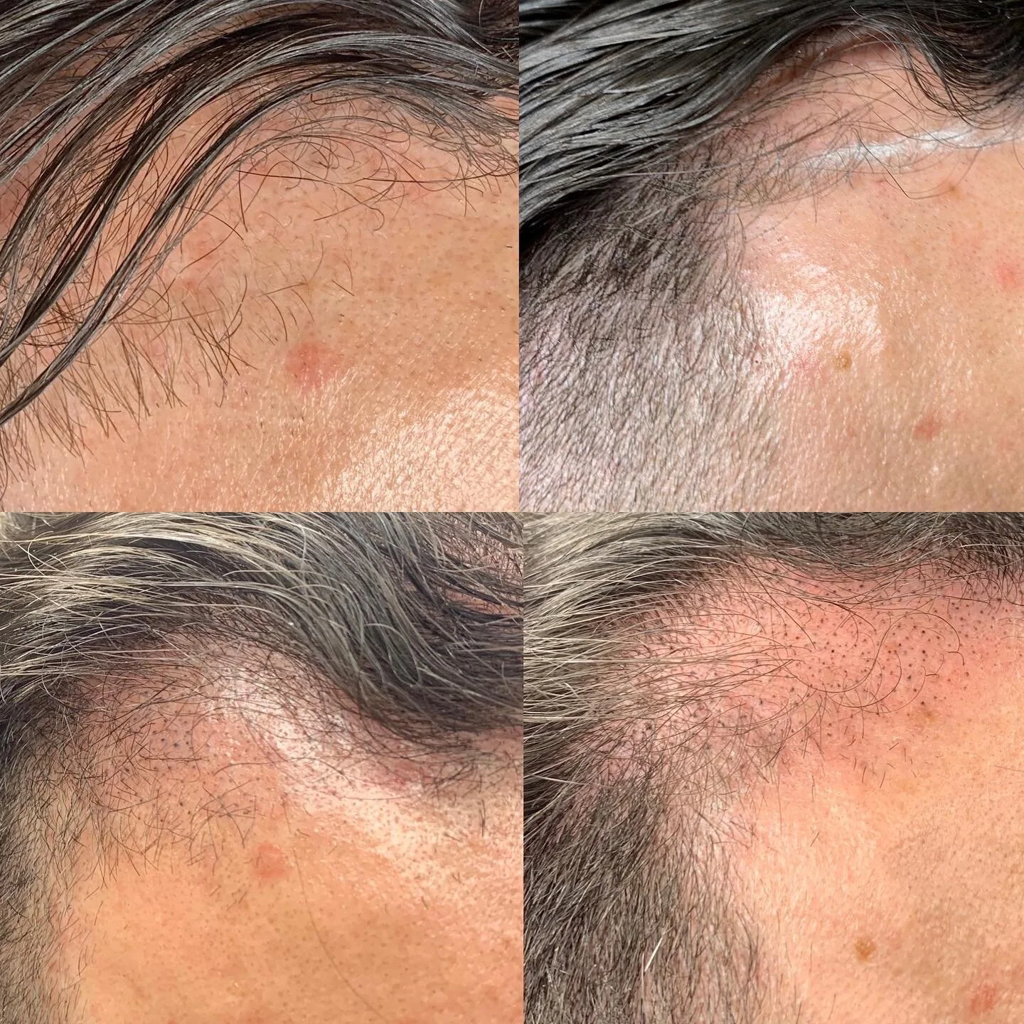 Top is before, below is after second session. A third will be required for final blending, but overall very happy with how this is coming along! 
Scalp micropigmentation is a modern treatment for hair loss that simulates hair follicles. It can be use