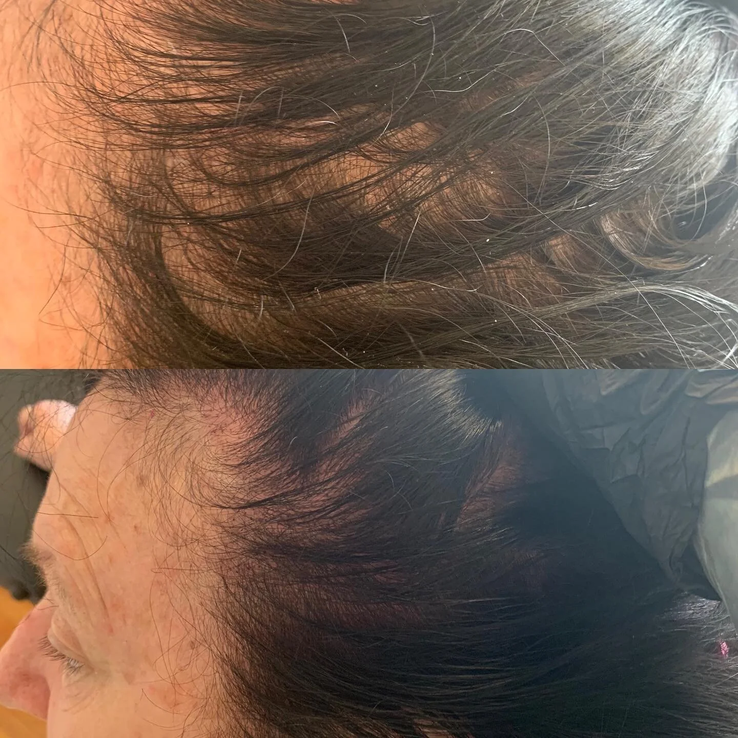First session. Client has traction alopecia and felt self conscious. Very excited to be able to restore the look of full hair for her! #scalpmicropigmentation #smp #densityfill #alopecia #microblading #pmu #atlanta #losangeles #tractionalopecia #thin