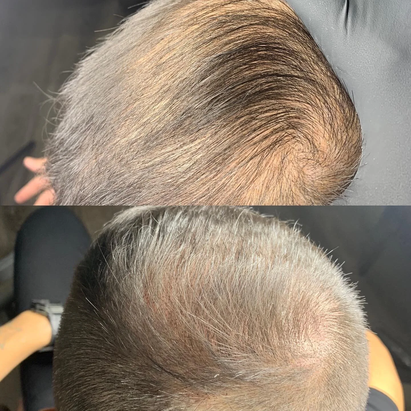 First session scalp micropigmentation. SMP is a non surgical, nearly painless cosmetic tattooing procedure that helps hide hair loss due to male pattern baldness, thinning hair, and alopecia,  suitable for both men and women! #scalpmicropigmentation 
