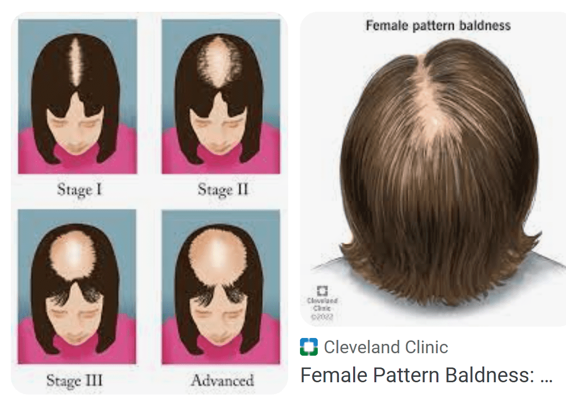 Fight Female Hair Loss Naturally