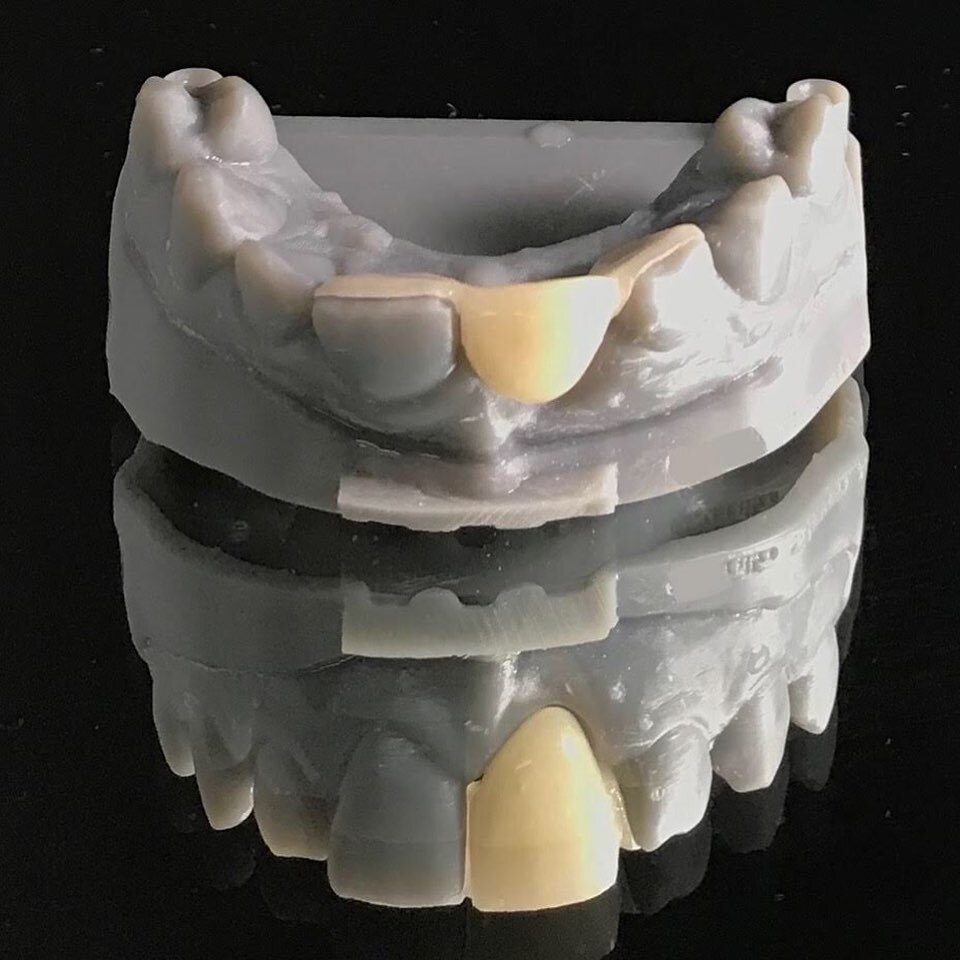 eMax Two Wing Maryland Bridge 🌉 #dentallab #emax #digitaldentistry #dentist #dentistry #prosthodontist