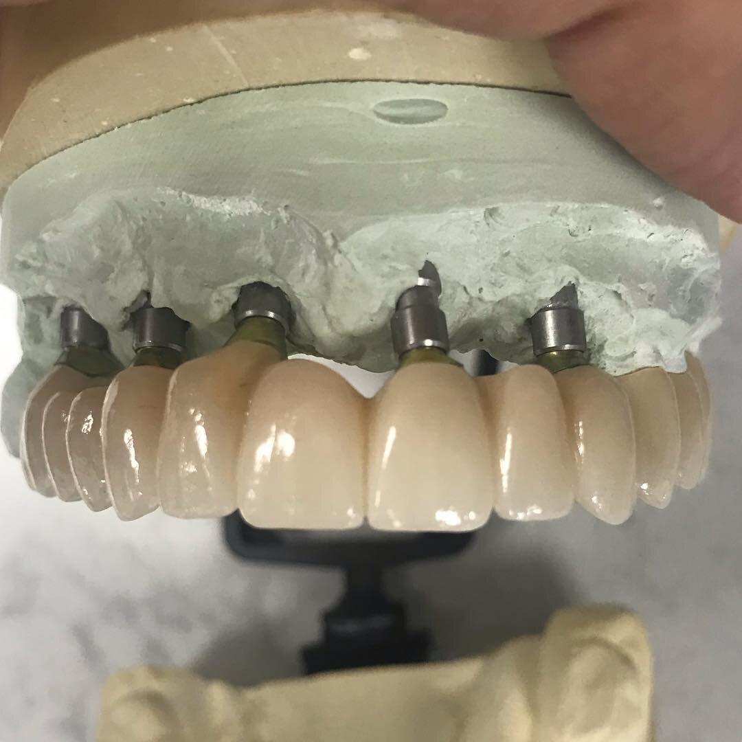 Full upper implant supported combination case! 💯✅