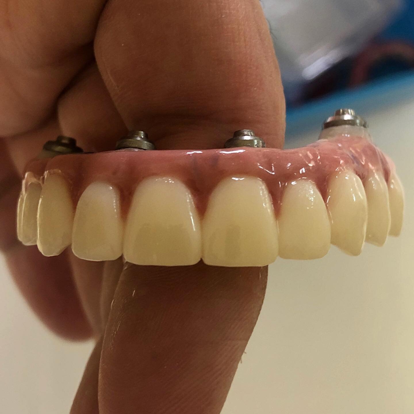 Our signature hybrid ✅ #dentalimplantsurgery #dentalimplants #dentalbridge #digitaldentistry #dentallab #dentaldesignsmile #beatifulsmile #teeth #fullmouthreconstruction