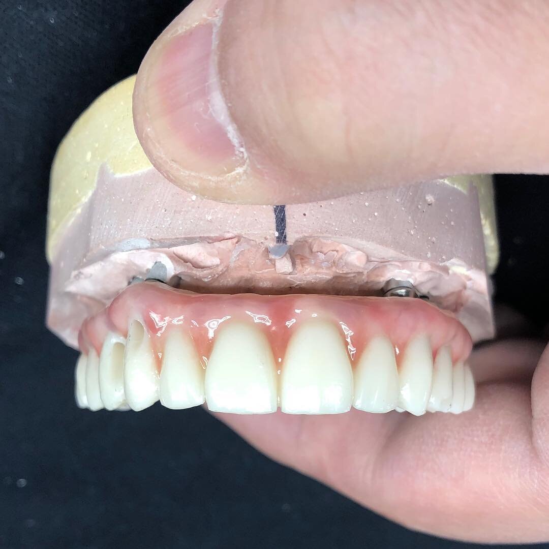 Hybrids is our specialty ✅💯👨🏻&zwj;💻 📱text or call us with any inquiries 212-457-4256 #dentalimplants #dentalimplantsurgery #dentaldesign #dentaltechnician #fullmouthrehabilitation #fullmouthreconstruction