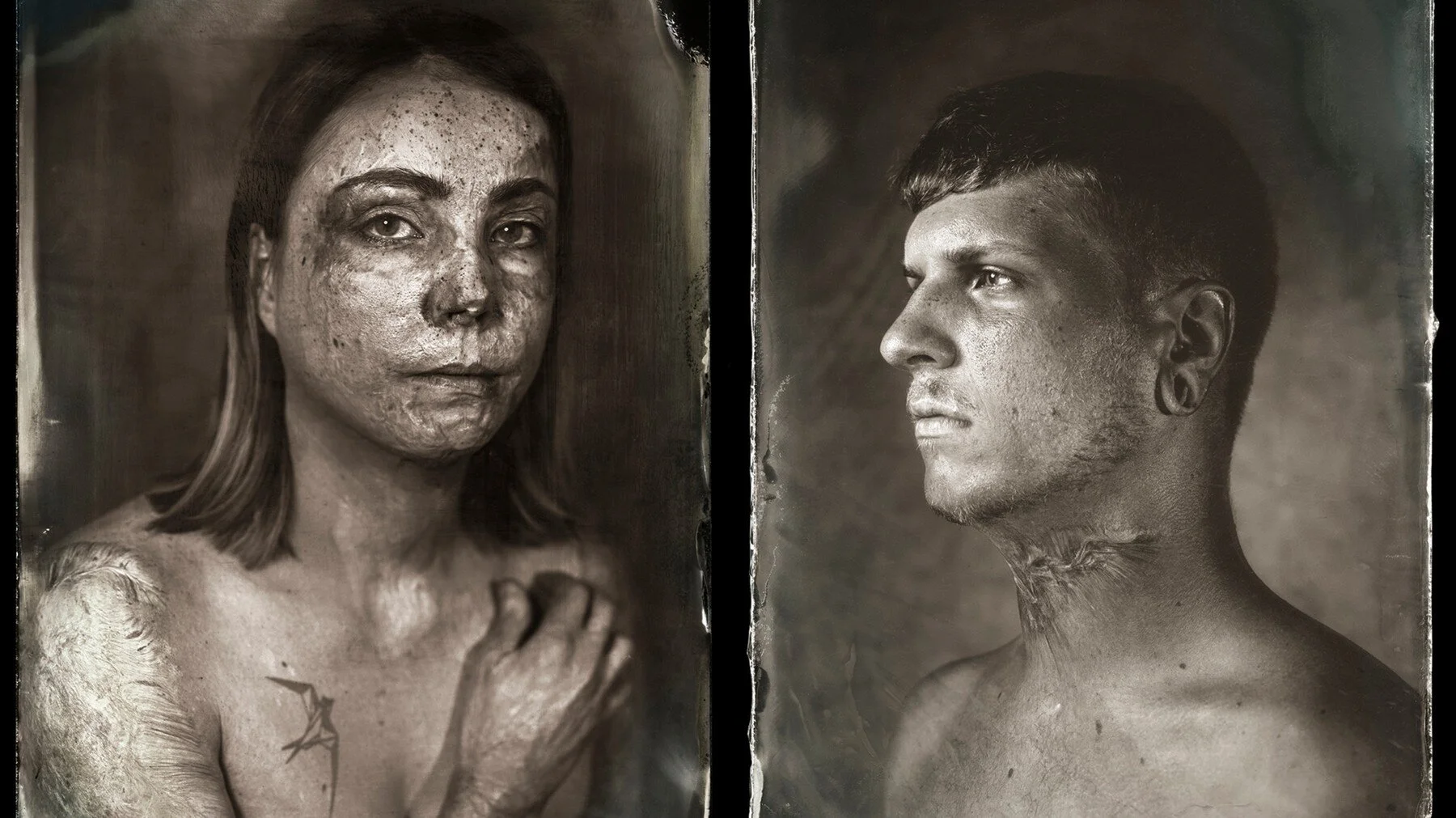 A Photographer and a Burn Survivor Find Beauty in Scars (July 2021)