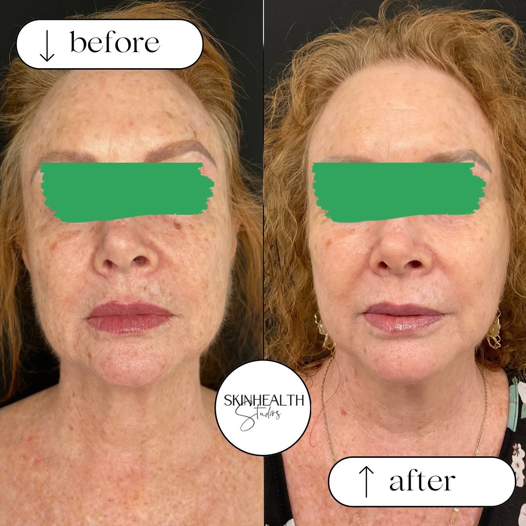 SKIN WIN WEDNESDAY: She came in frustrated with sun damage, uneven tone, and dull skin that no skincare product was touching. ☀️➡️✨
This is what happens when we go beneath the surface.
LaseMD Ultra works at the dermal level &mdash; targeting pigmenta