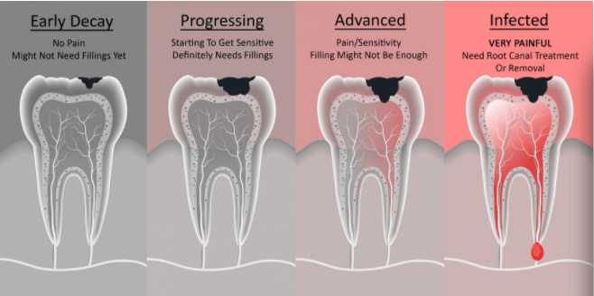 Kingston Beach Dental - Restorative Care -Root Canal