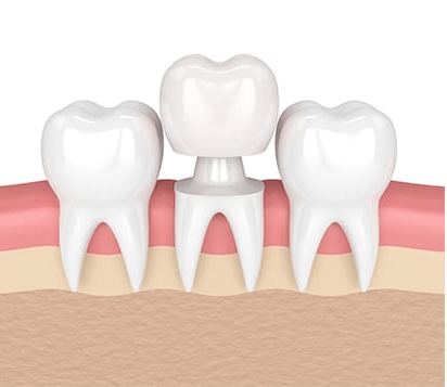 Kingston Beach Dental - Restorative Care - Crowns