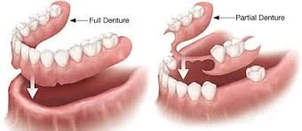 Kingston Beach Dental - Restorative Care - Dentures
