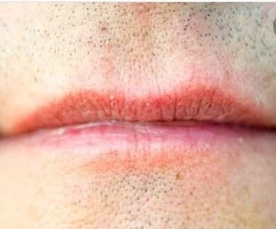Dry Mouth.JPG