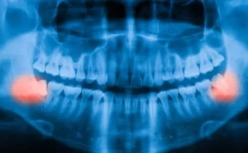 Wisdom Teeth.jpg