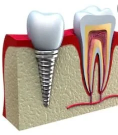 Implants.JPG