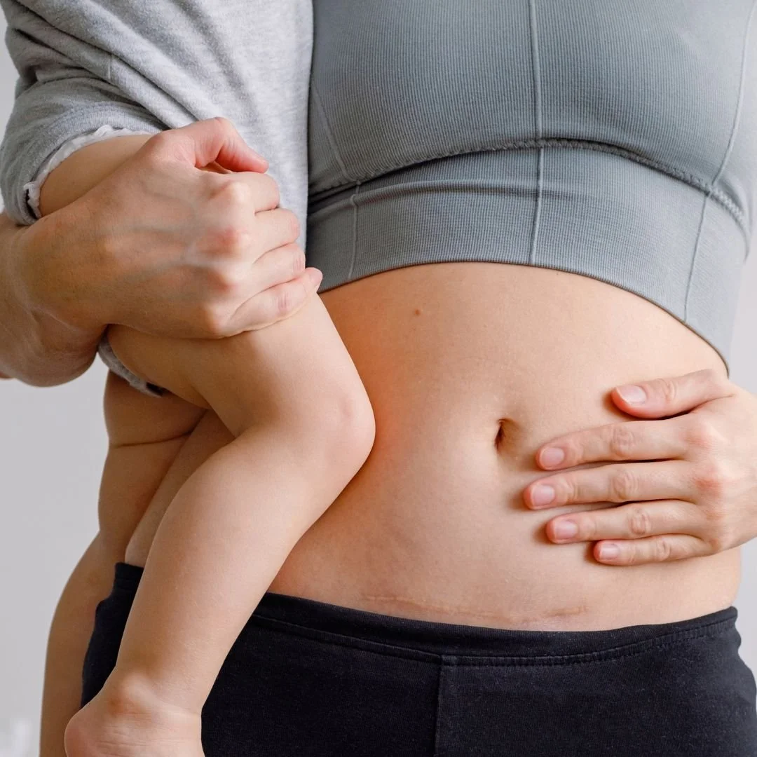 Jizva nen&iacute; jen na kůži. 🤲

Může ovlivňovat pohyb, způsobovat napět&iacute; nebo bolest i dlouho po zahojen&iacute;. V CH&rsquo;I centru se zaměřujeme na odbornou terapii jizev po operac&iacute;ch, &uacute;razech i c&iacute;sařsk&yacute;ch řez