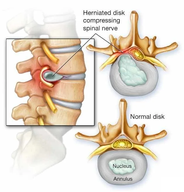 Spine Compression Basics — Laevo Exoskeletons