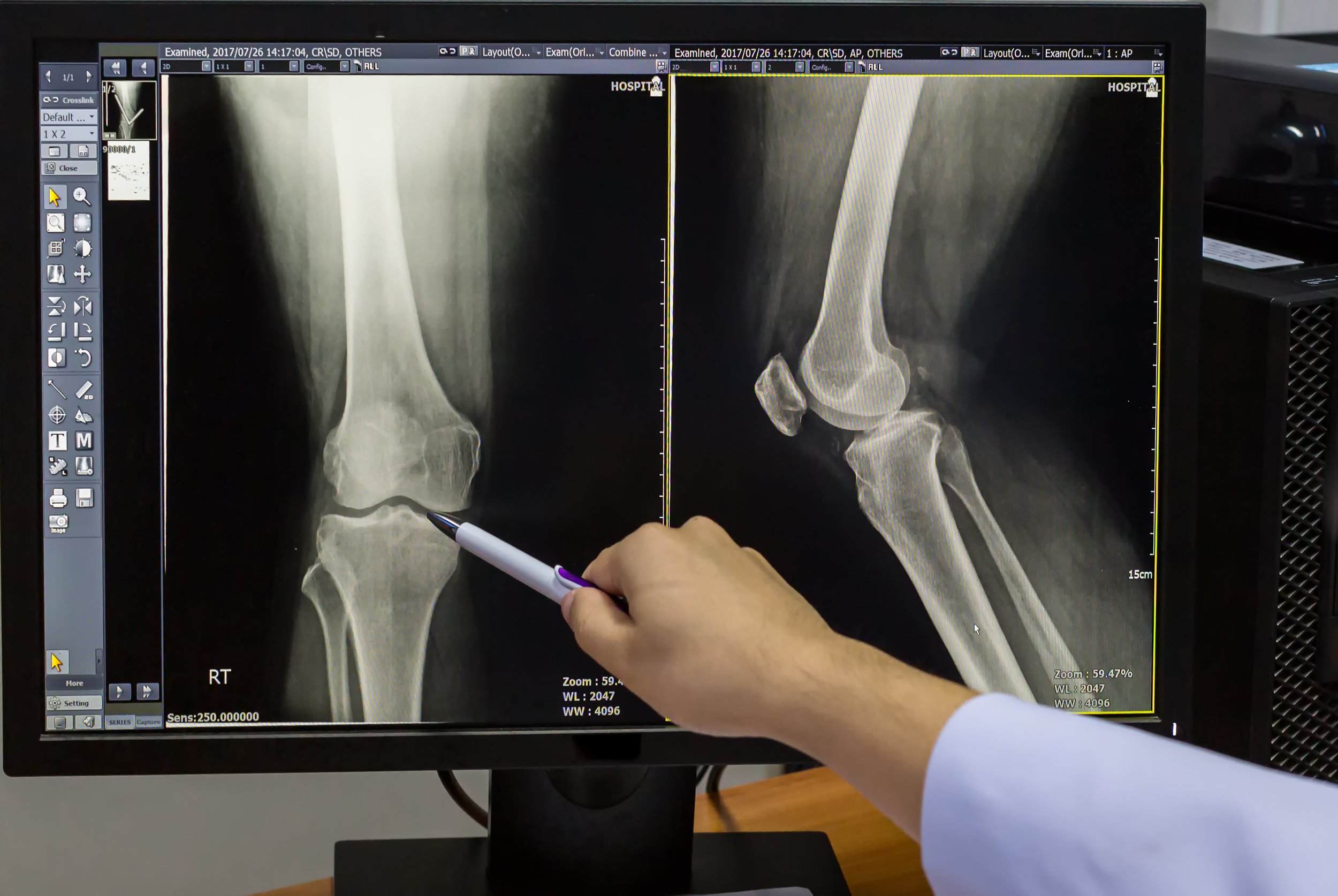 Artoplastia total de rodilla sin el uso de torniquete