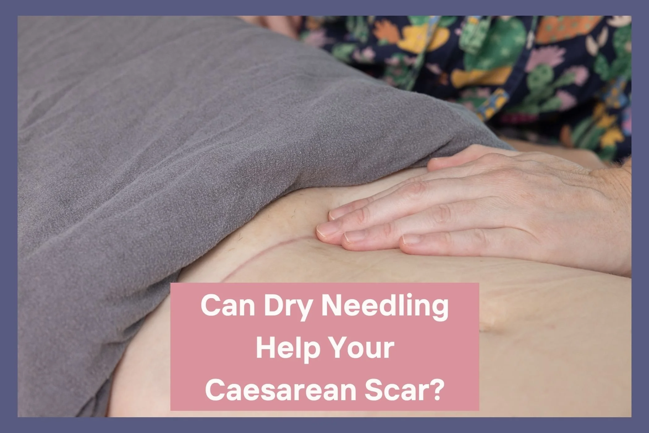 Can Dry Needling Help Your Caesarean Scar?