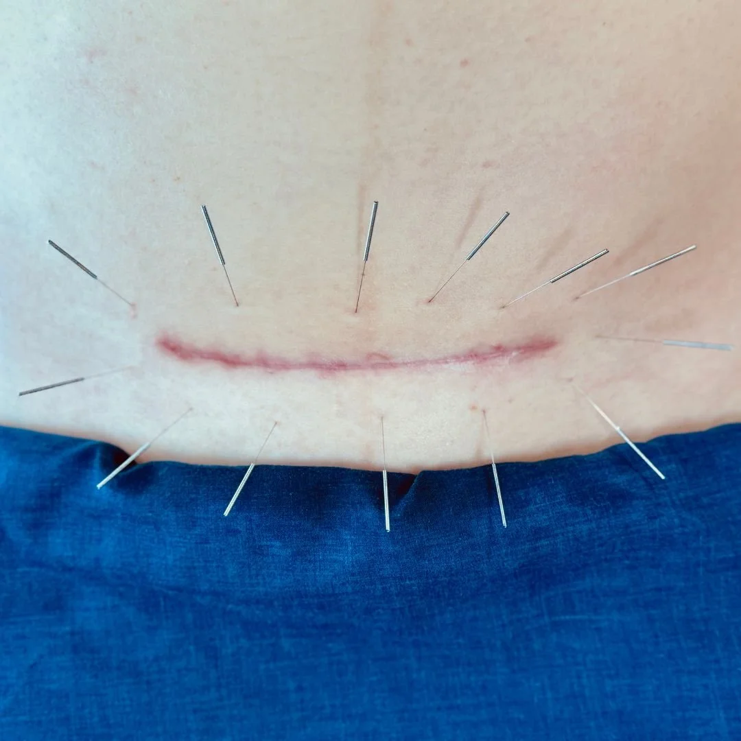Illustration of dry needling treatment around a caesarean scar to support scar mobility
