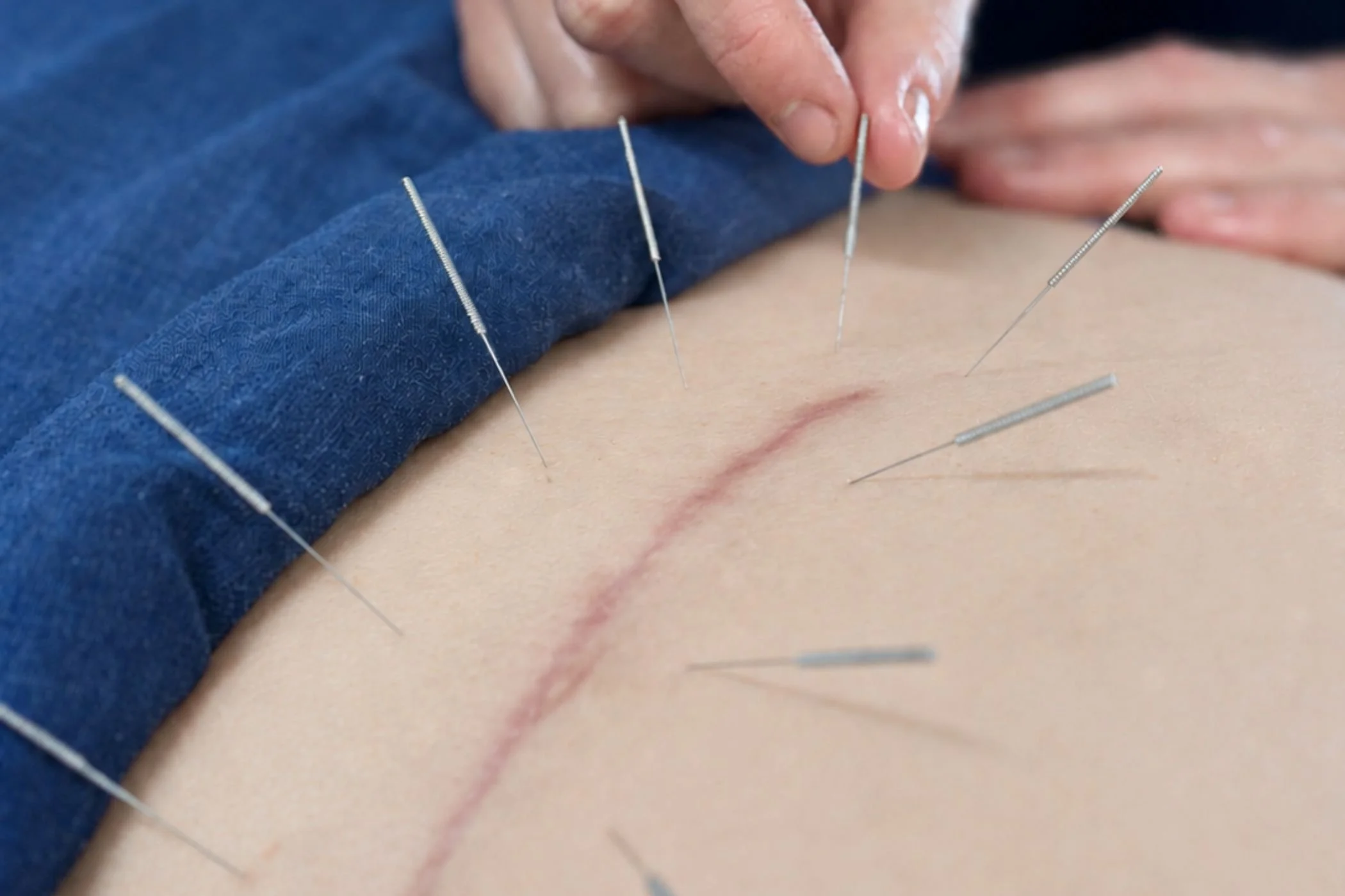 Osteopath using dry needling as part of treatment for a Caesarean scar