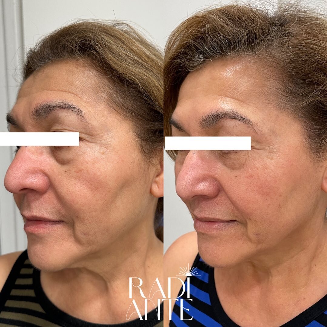 Jet Plasma, after 3 sessions in, but still not the &ldquo;After&rdquo; results. Remarkable. Texture, pigment, lines, firmness, even tone, eye bags&mdash; and the list of improvements goes on and on. This painless treatment is safe to do year-round an