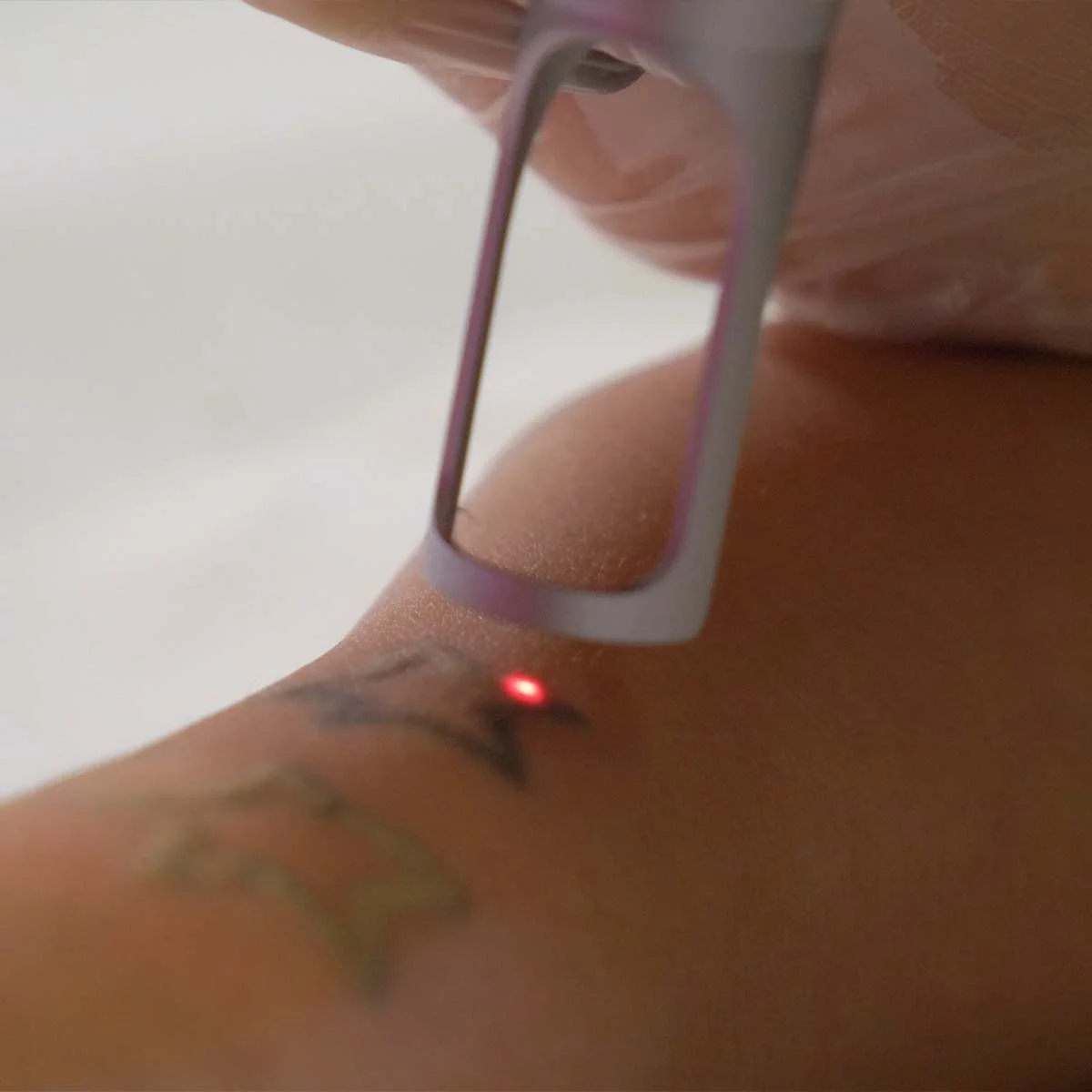 Laser removes tattoo from skin