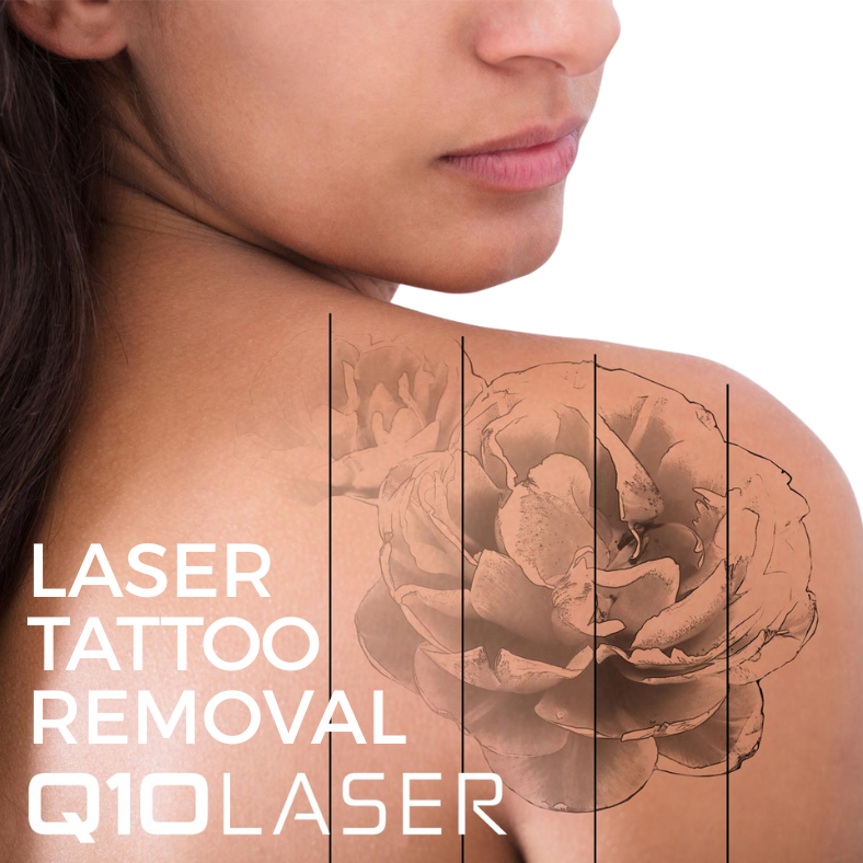 Laser tattoo removal image showing tatto as it fades with treatment on a ladies shoulder