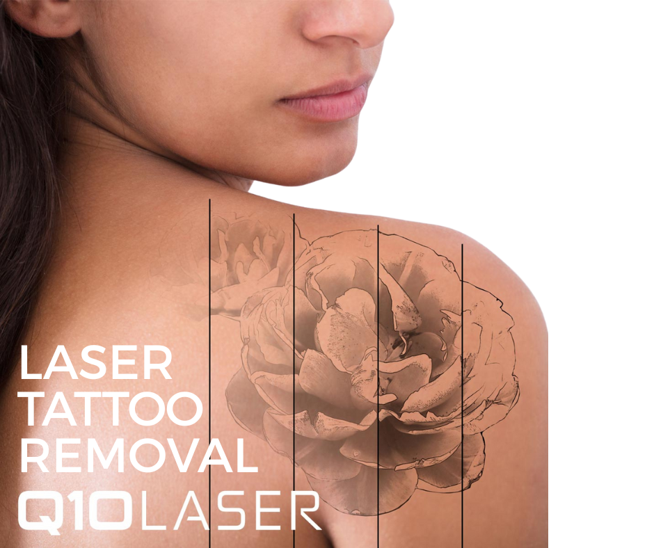 Image showing Laser Tattoo Removal n stages